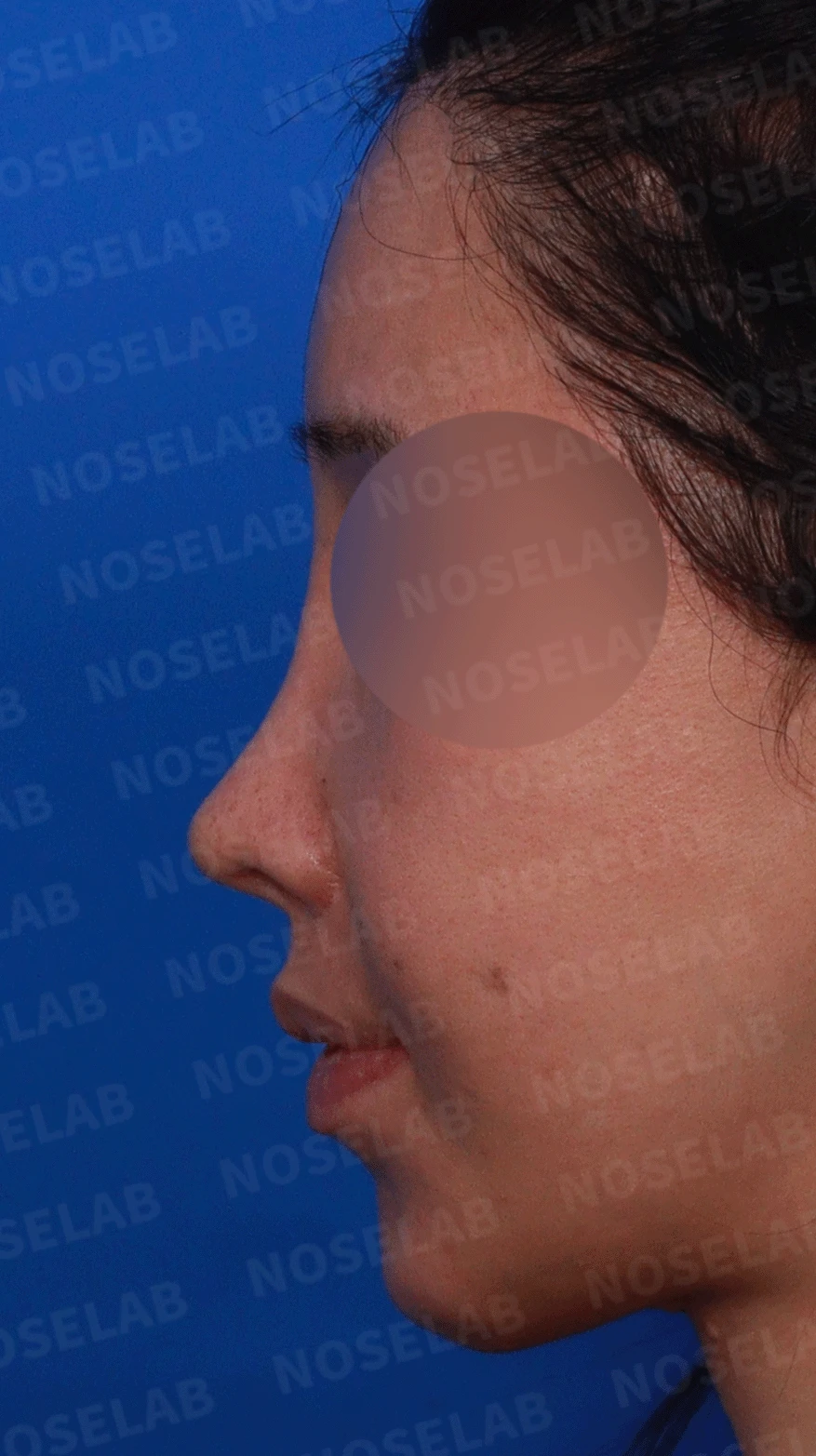 다수 재수술 후 인공진피 흡수와 비중격 손상 재건 사례 — 디자인 상담 정면 , 좌측 측면, 비스듬한 측면 사진