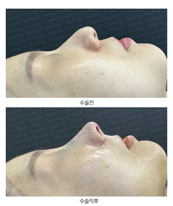복코, 퍼진코 교정 수술 사례 — 전후 비교