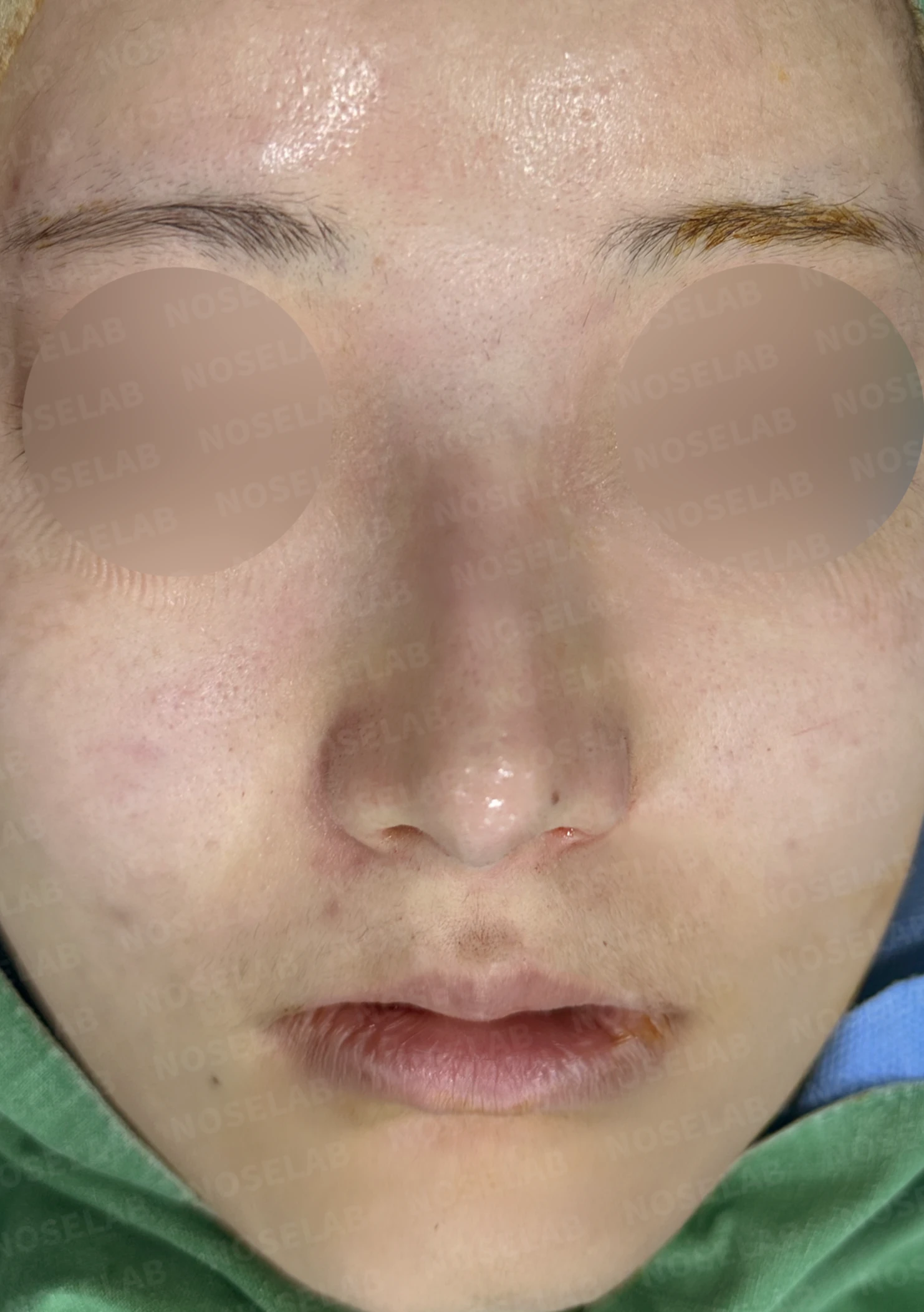 코필러 제거 후 자가늑연골 코성형, 처진 코끝과 메부리코를 자연스럽게 교정 — 직후 정면, 비스듬한 측면, 측면 사진입니다.