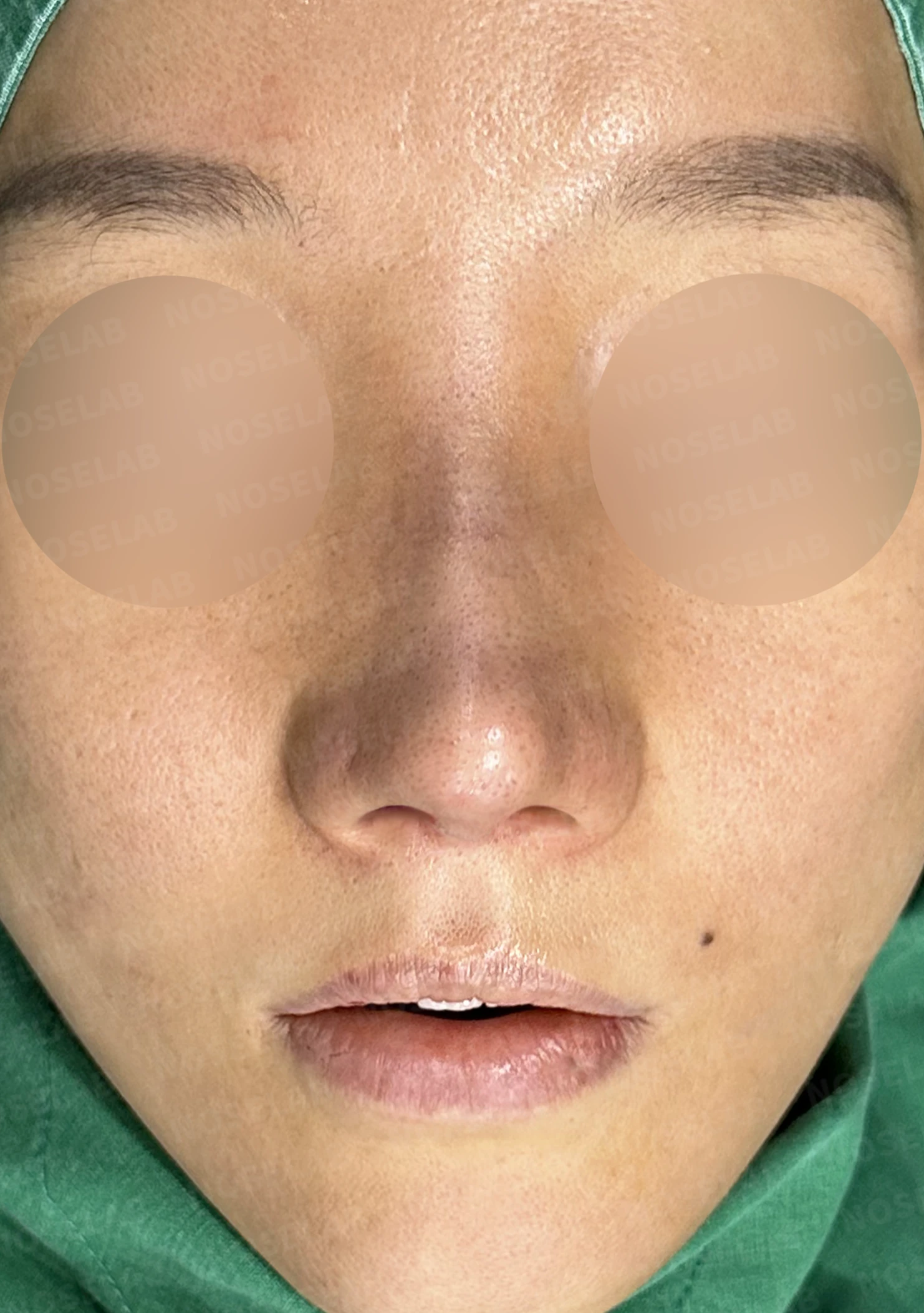 여러 번의 코재수술 뒤 비중격이 무너지는 이유, 자가늑연골 전면 재건은 어떻게 하나 — 수술 직후 0일 정면, 비스듬한 측면, 측면 사진입니다. 직후 사진은 부기가 있는 상태로 최종 결과와 다를 수 있습니다.