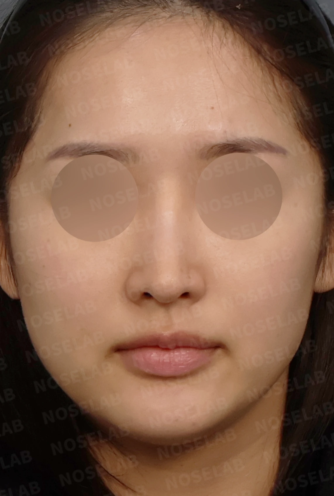 코성형 뒤 코끝이 처져 코가 길어 보이는 이유, 자가늑연골 코끝 재건 방법 — 디자인 상담 정면, 좌측 측면, 비스듬한 측면 사진입니다.