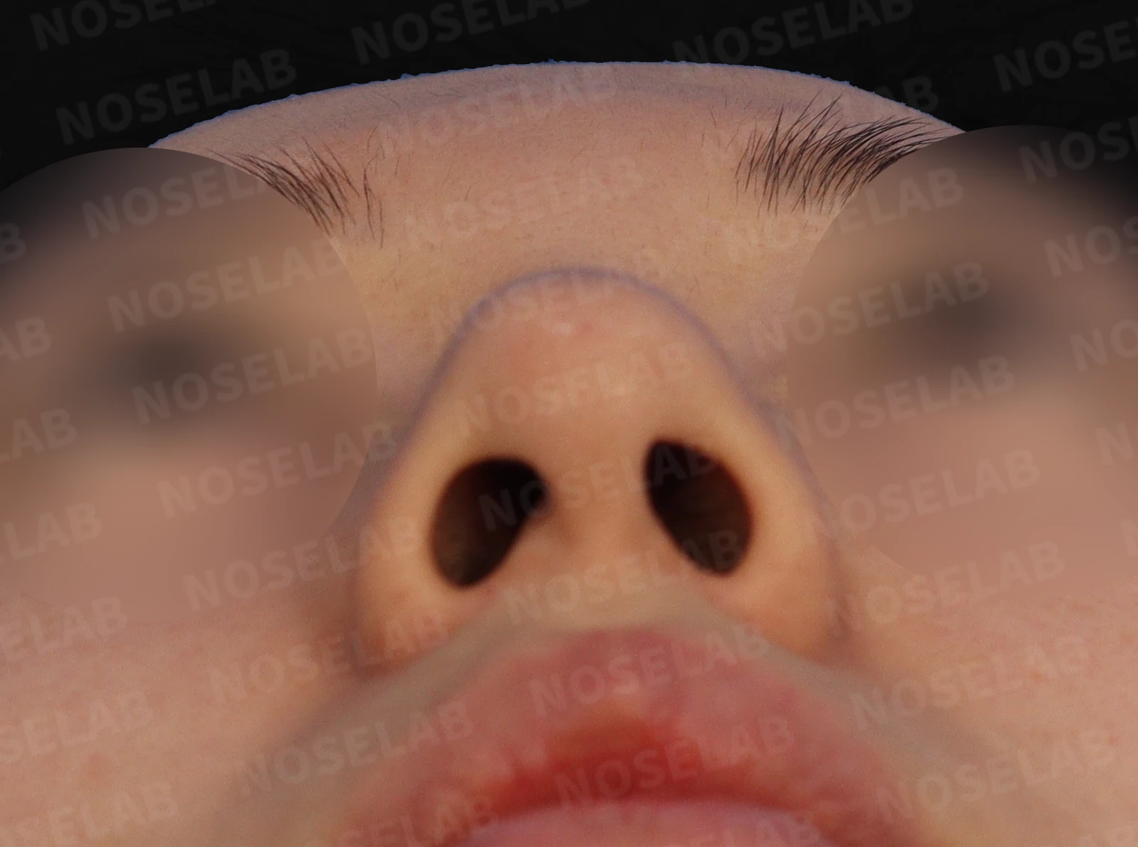 뭉툭한 복코의 구조와 교정 방법 — 본문 사진 4
