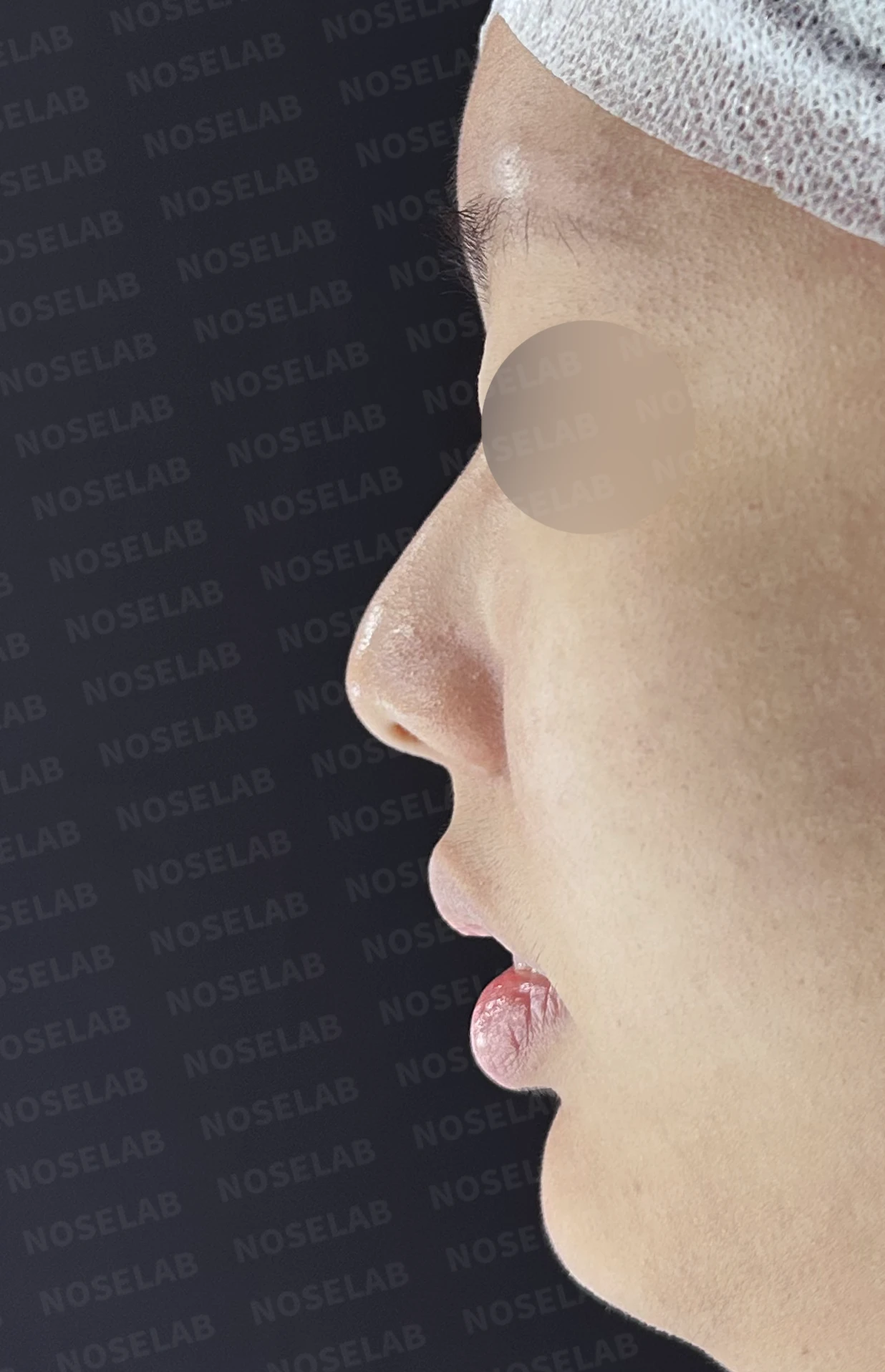 휘어진 매부리와 처진 코끝이 생기는 이유, 비중격 연장술은 어떻게 하나 — 수술 전 / 수술 직후 0일 직후 사진은 부기가 있는 상태로 최종 결과와 다를 수 있습니다.