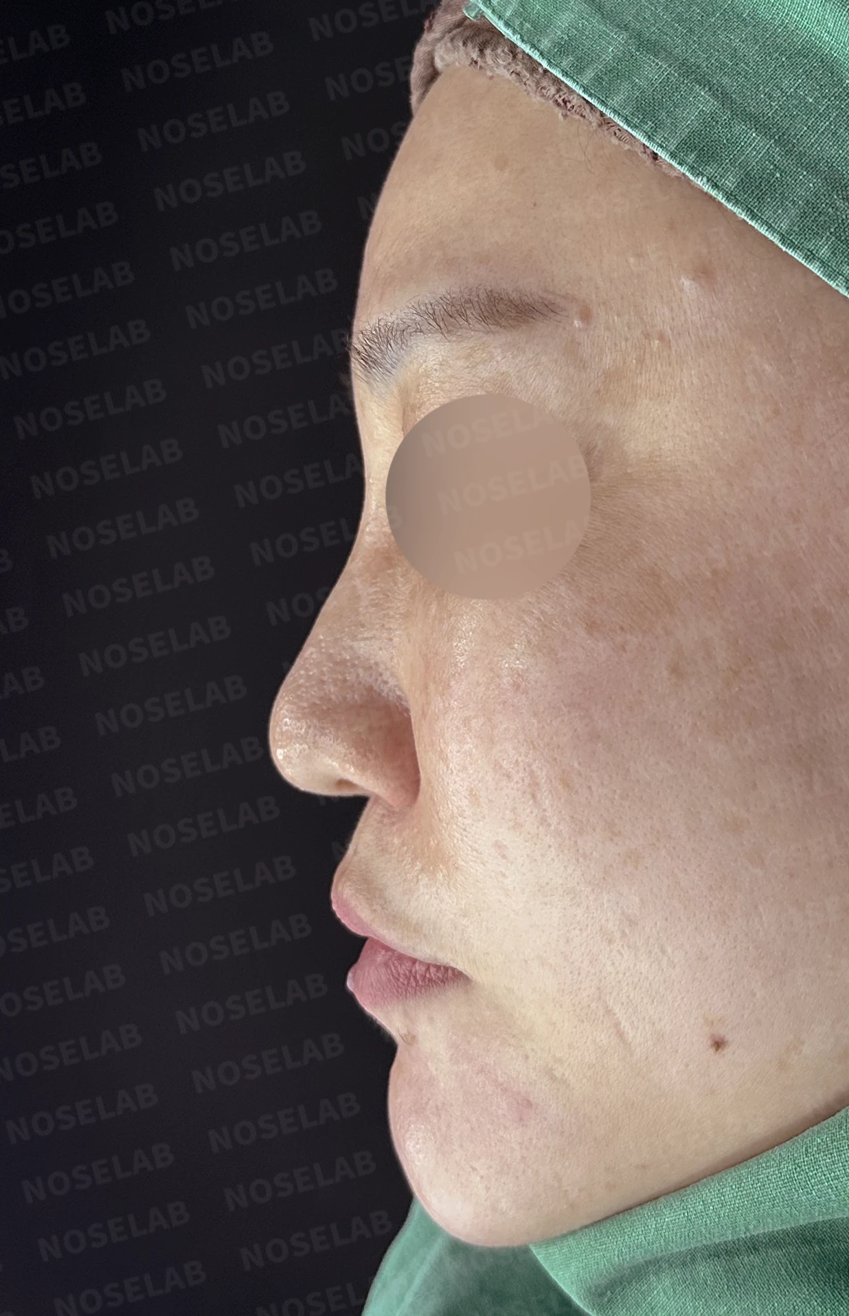 뭉툭하고 길게 처진 코가 중안면부를 길어 보이게 하는 이유, 석회화된 늑연골 재건 방법 — 수술 전 / 수술 직후 0일 직후 사진은 부기가 있는 상태로 최종 결과와 다를 수 있습니다.