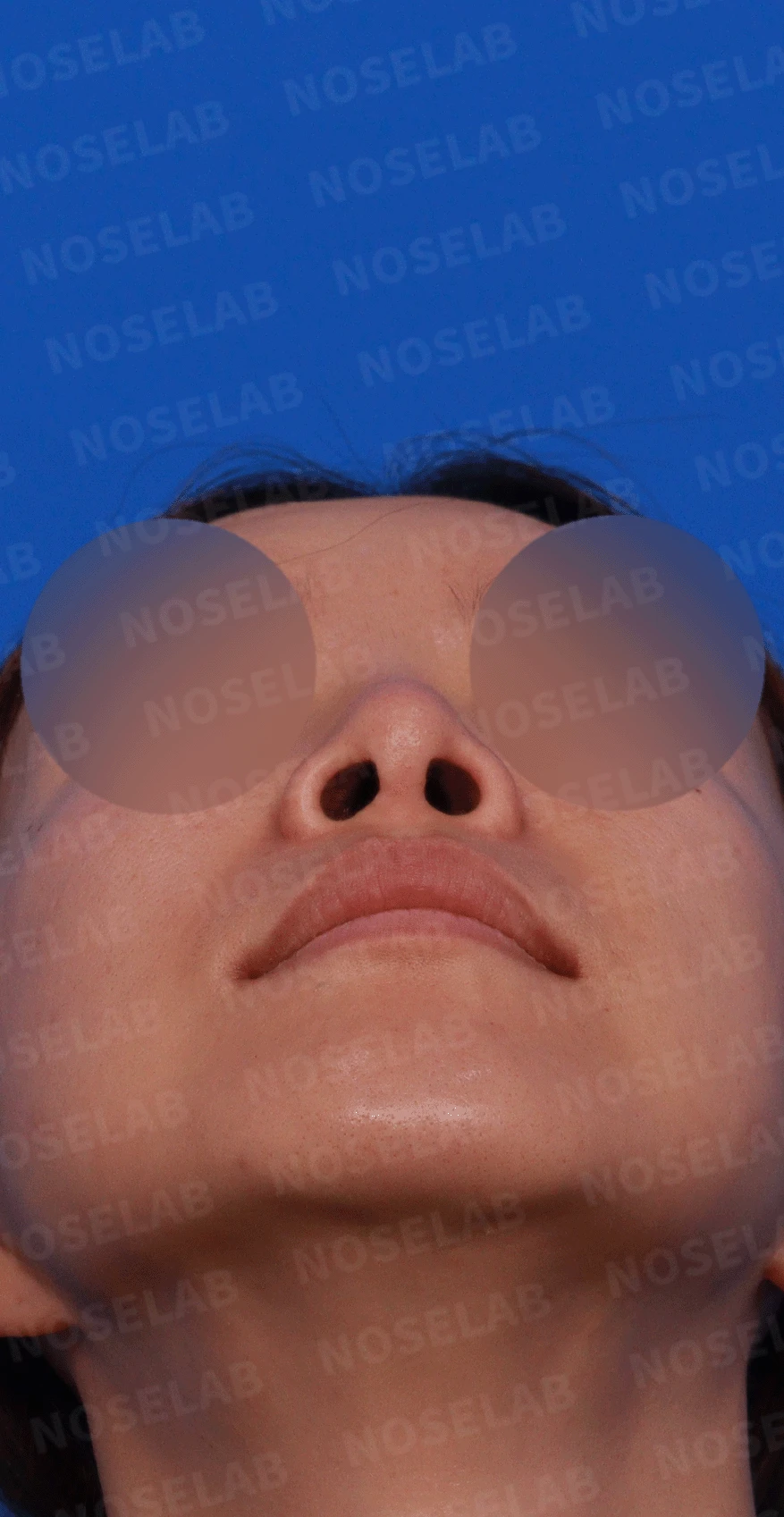 후비루와 코끝 처짐이 함께 나타나는 이유, 비중격 연장과 기능 수술은 어떻게 하나 — 디자인 상담 우측 측면 , 비스듬한 측면 , 비공 사진