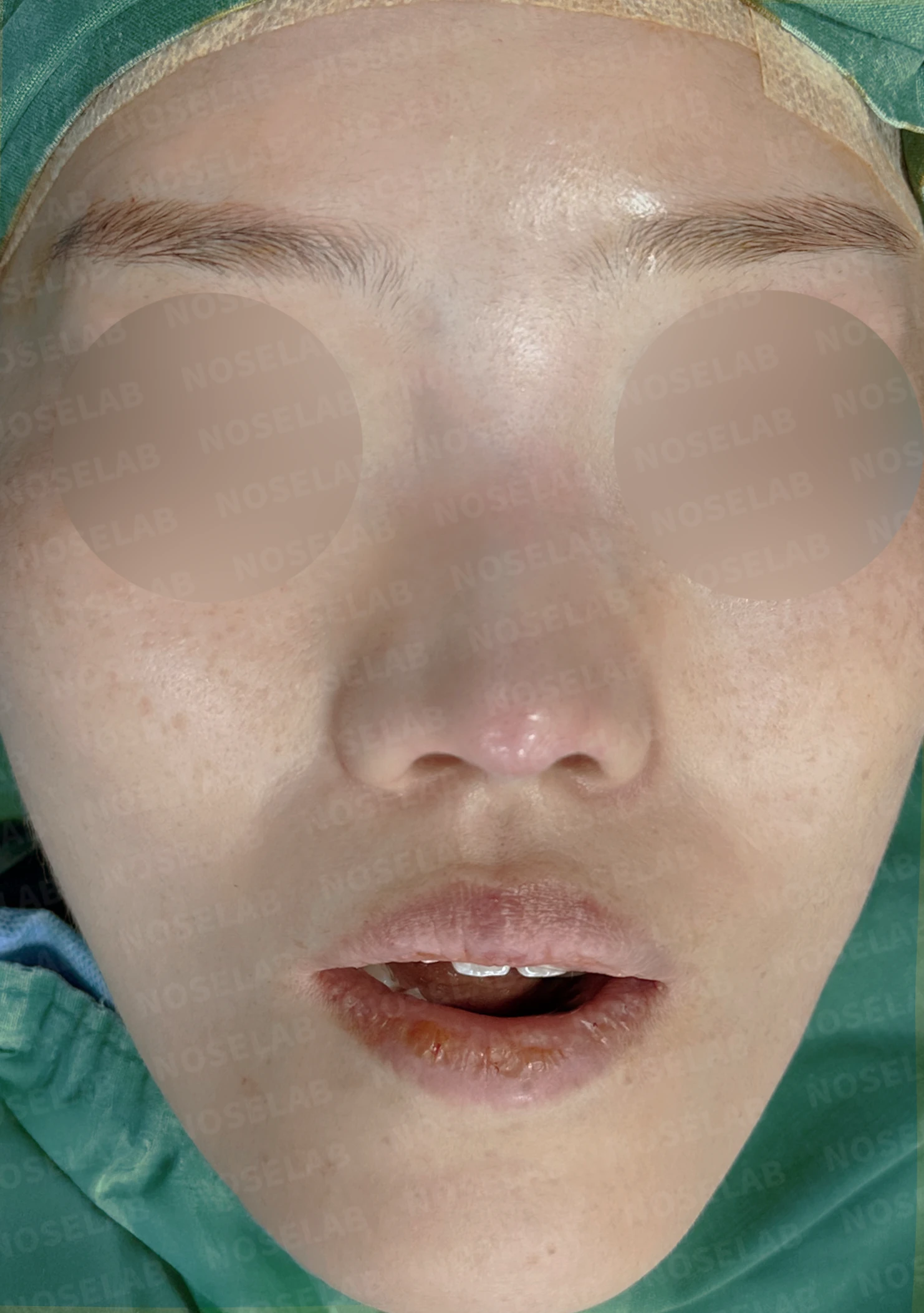 짧고 들린 코와 휜 코가 함께 생기는 이유, 비중격 연장 교정은 어떻게 하나 — 수술 직후 0일 정면, 비스듬한 측면, 측면 사진입니다. 직후 사진은 부기가 있는 상태로 최종 결과와 다를 수 있습니다.