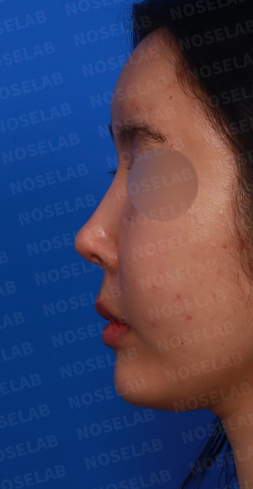 코가 들리고 콧기둥이 꺼지며 코끝이 찝혀 보이는 이유, 복합 교정은 어떻게 하나 — 디자인 상담 정면, 좌측 측면, 비스듬한 측면 사진