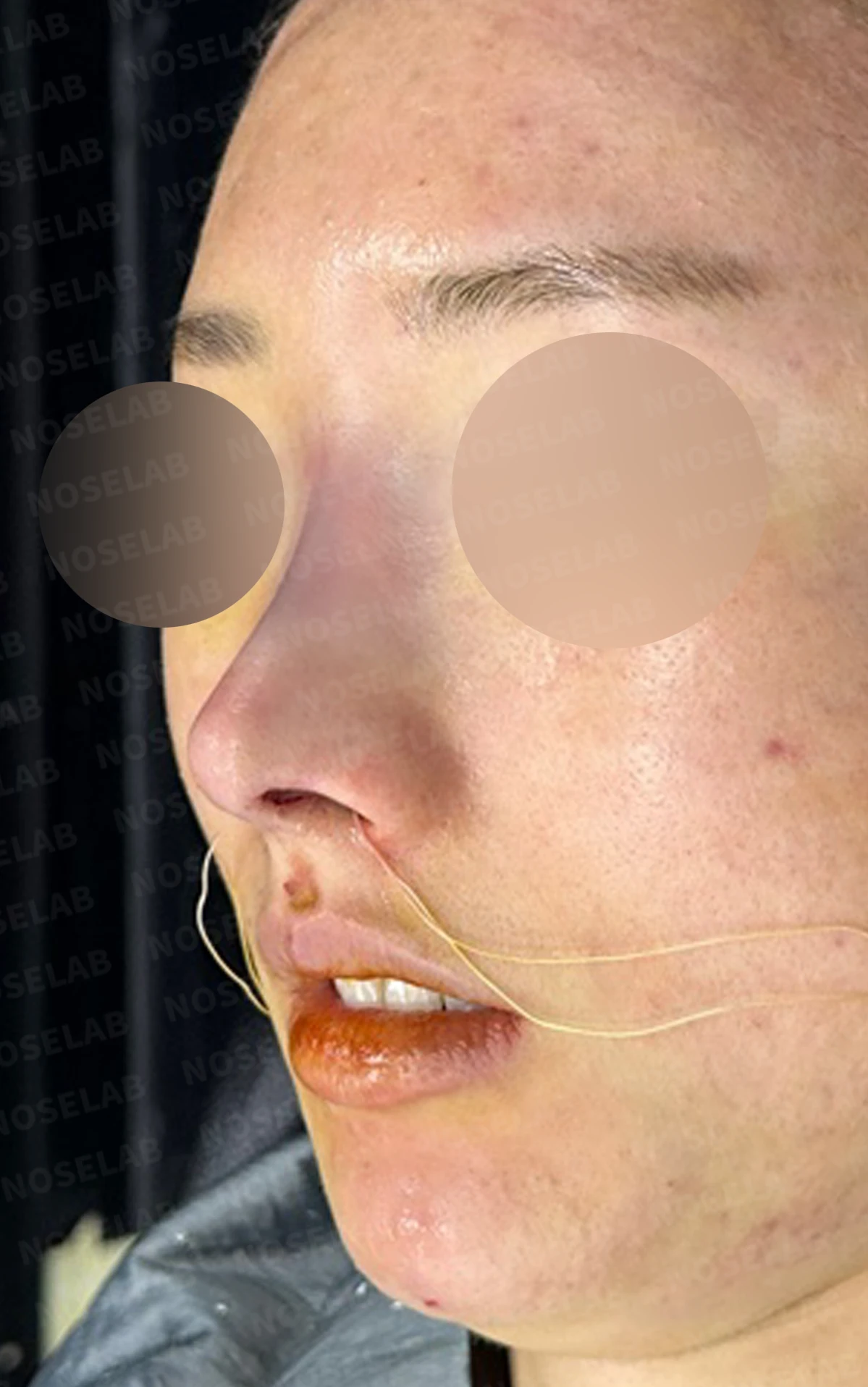 코 필러 뒤에도 휜 코와 코막힘이 남는 이유, 교정은 어떻게 하나 — 수술 전 / 수술 직후 0일 직후 사진은 부기가 있는 상태로 최종 결과와 다를 수 있습니다.