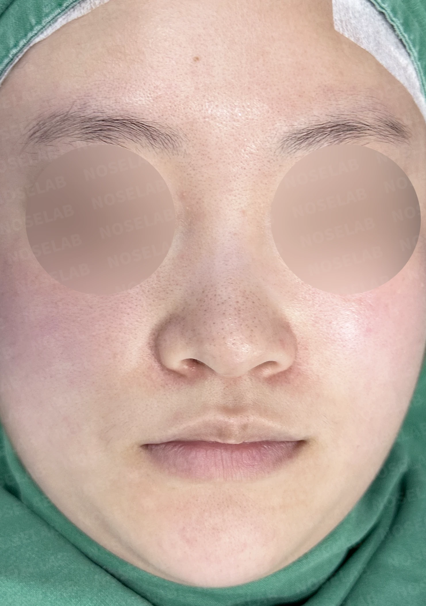 코가 퍼지고 코끝이 뭉툭해 보이는 이유, 비중격연골과 귀연골 교정은 어떻게 하나 — 수술 전 / 수술 직후 0일 직후 사진은 부기가 있는 상태로 최종 결과와 다를 수 있습니다.