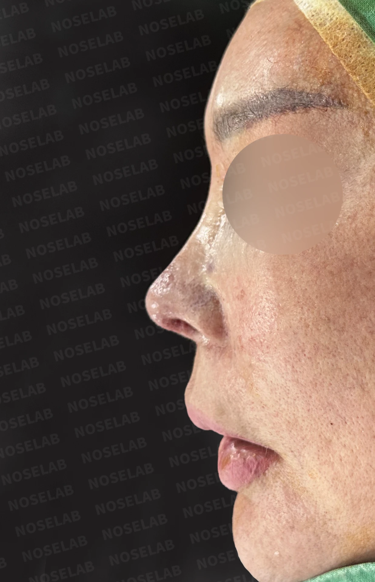 보형물 염증으로 손상된 코, 휴식기 후 기증늑연골로 안전하게 재건한 코재수술 — 직후 정면, 비스듬한 측면, 측면 사진입니다.