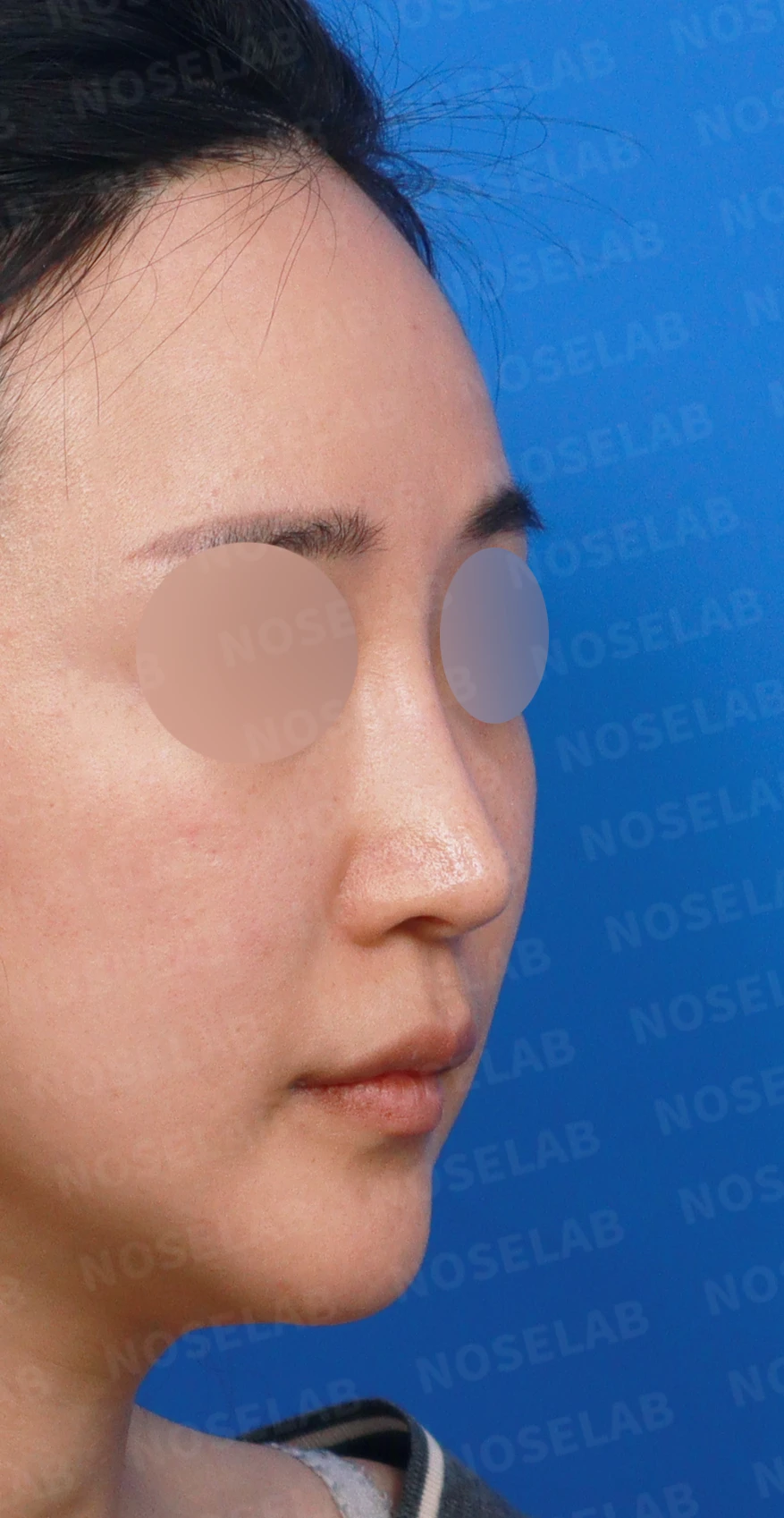 여러 번 수술한 코의 L-strut이 얇아지는 이유와 구조적 재건 방법 — 디자인 상담 우측 측면, 비스듬한 측면, 비공 사진