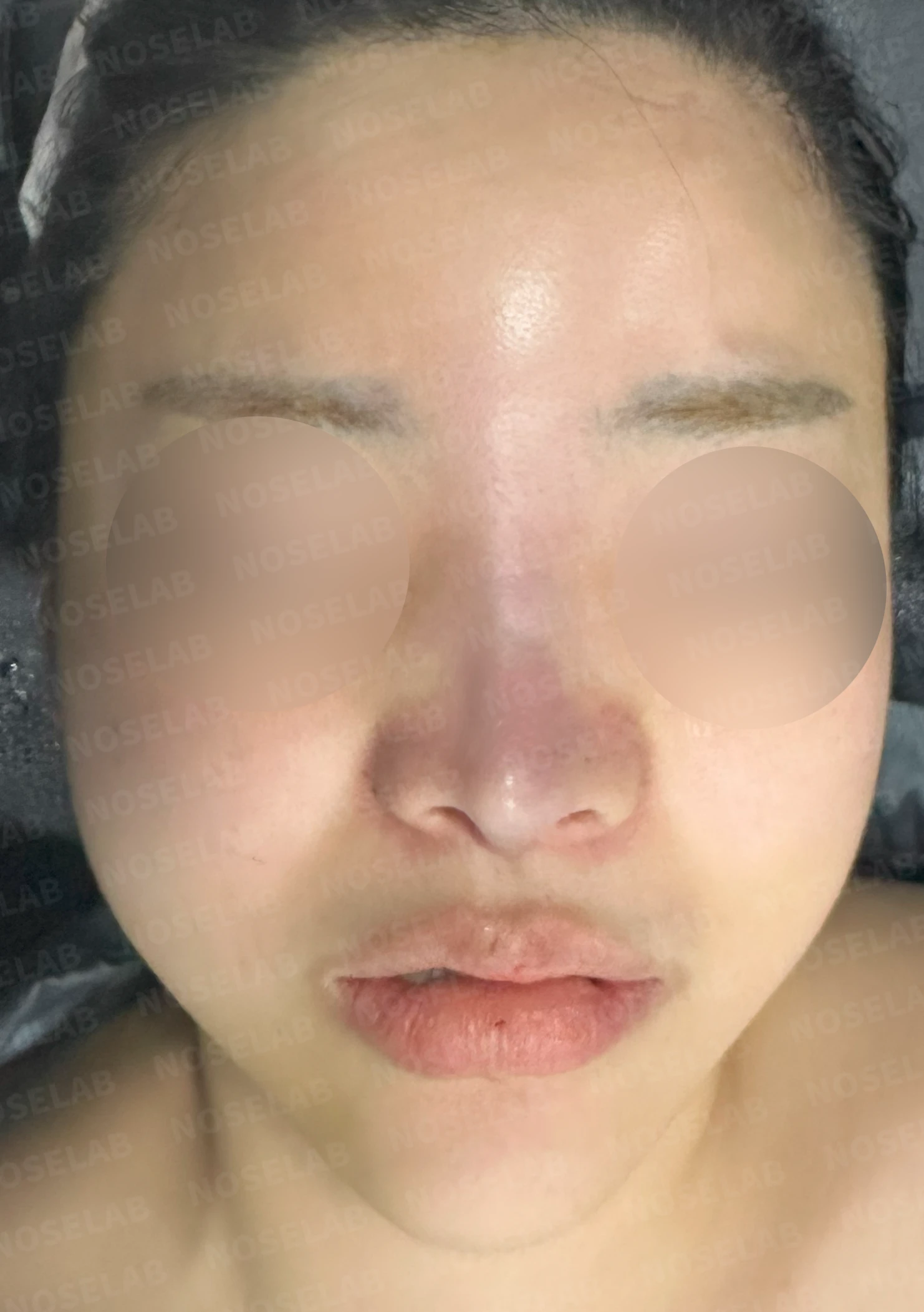 퍼진 콧대와 들린 코끝은 왜 생기나, 늑연골 재건은 어떻게 하나 — 수술 직후 0일 정면, 측면, 비스듬한 측면 사진 직후 사진은 부기가 있는 상태로 최종 결과와 다를 수 있습니다.