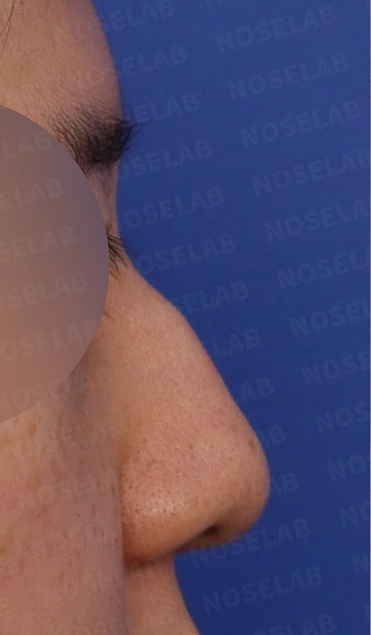 매부리 코·휜 코·뭉툭한 코·콧구멍 비대칭 교정 코 수술 방법 — 본문 사진 1