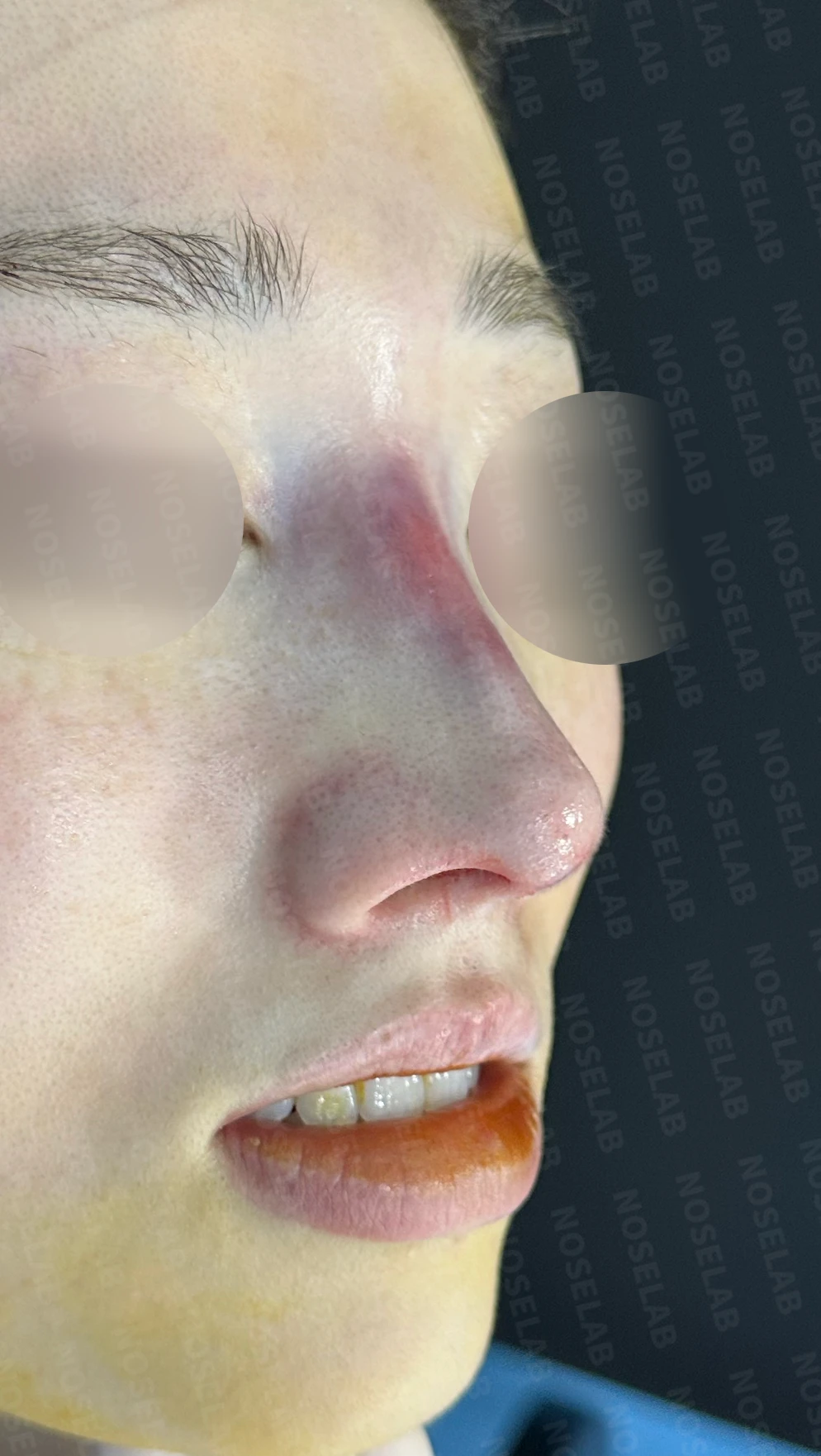 이물질(메쉬·실) 제거후 코성형 방법 — 수술 직후 0일 정면, 측면, 비스듬한 측면 사진 직후 사진은 부기가 있는 상태로 최종 결과와 다를 수 있습니다.