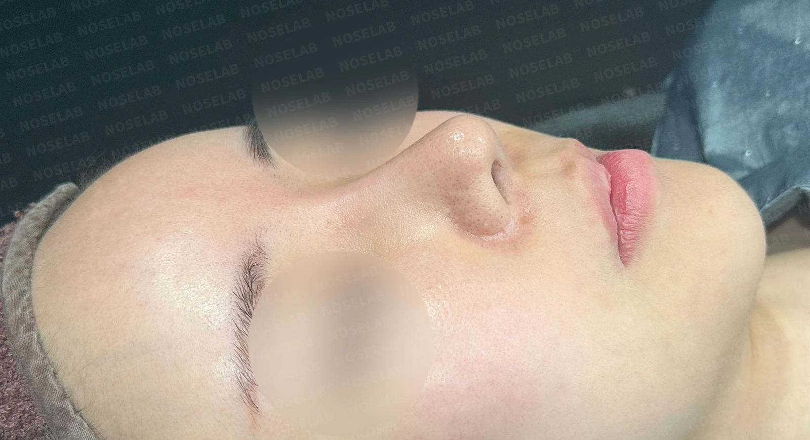 다섯 번의 수술 끝에 찾은 완벽한 코: 들린코와 휜코의 극적인 변신 — 수술전(좌) 수술직후(우)