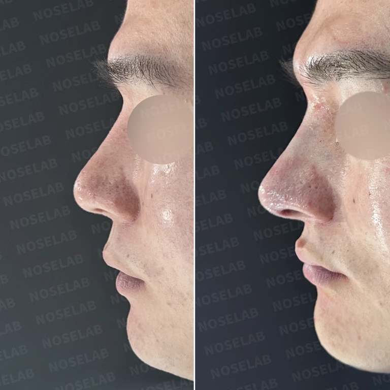 높은 코를 원한다면? 3D 맞춤 보형물과 자가늑연골로 완성한 이상적인 콧대 — 전후 비교