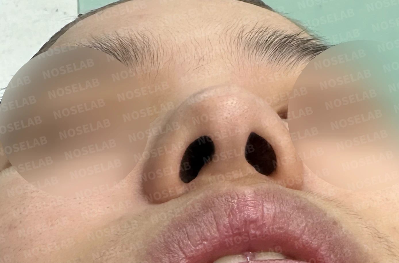 뭉툭하고 퍼진 코의 교정 방법 — 수술 전 / 수술 직후 0일 직후 사진은 부기가 있는 상태로 최종 결과와 다를 수 있습니다.