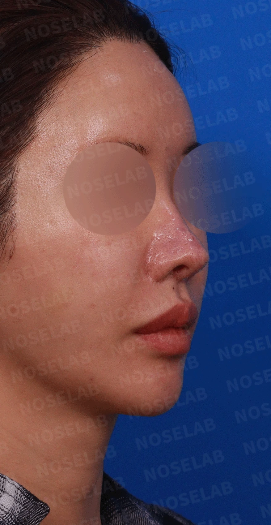 코 수술 뒤 콧등 피부가 괴사하면 어떤 변화가 남고, 재건은 어떻게 하나 — 디자인 상담 정면 , 비스듬한 측면 사진, 우측 측면