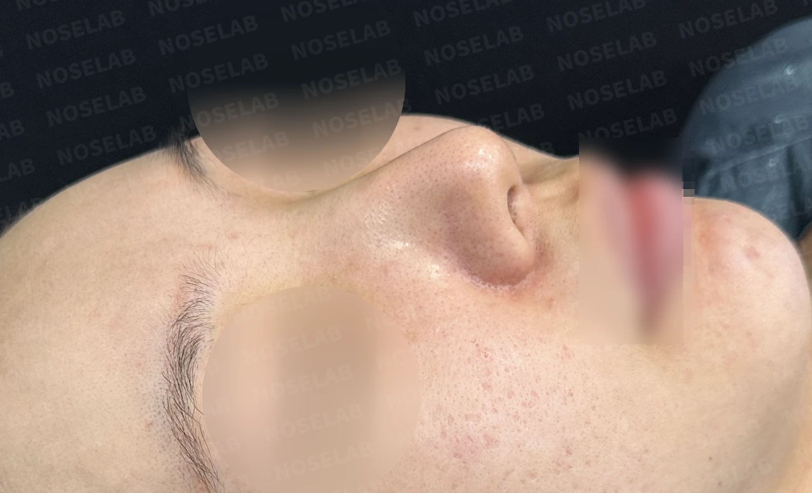 반복 수술 후 긴 코와 높은 시작점의 재수술 방법 — 수술 전 / 수술 직후 0일 직후 사진은 부기가 있는 상태로 최종 결과와 다를 수 있습니다.