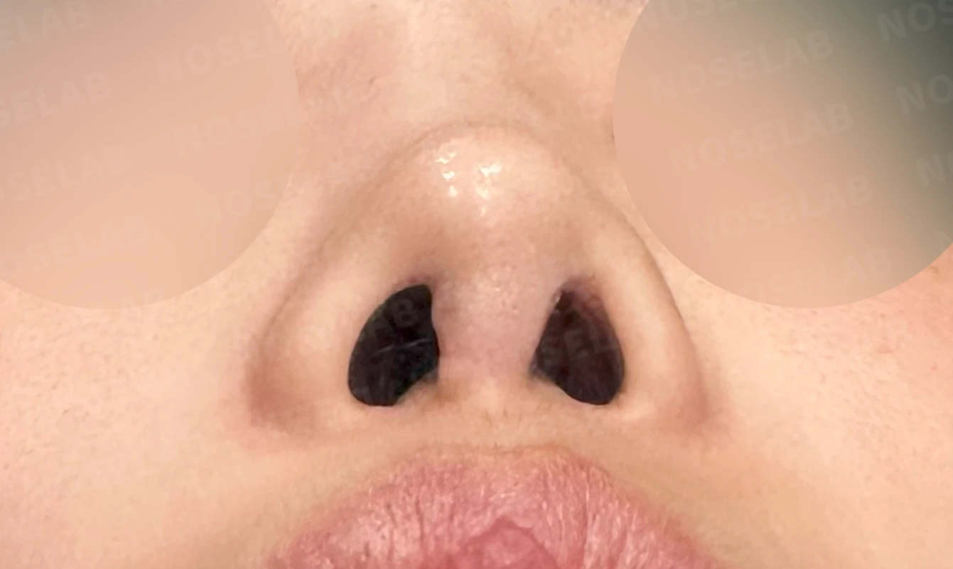 보형물을 넣고 빼기를 반복한 코에 남는 콧등 패임과 들린 느낌 — 수술 전 / 수술 직후 0일 직후 사진은 부기가 있는 상태로 최종 결과와 다를 수 있습니다.