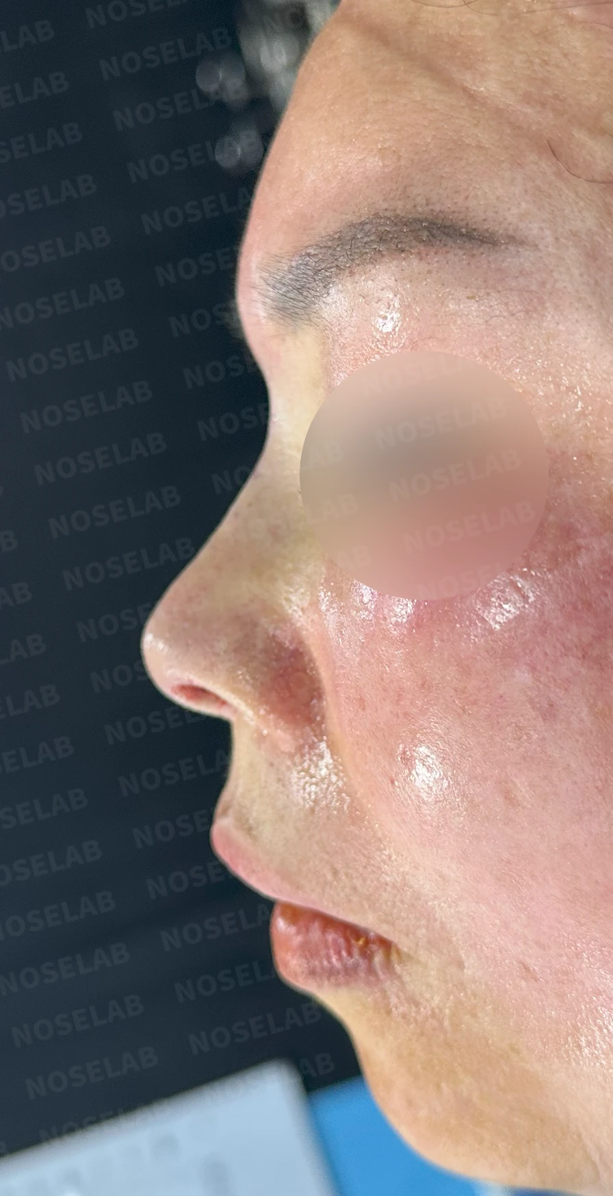 불법 주사 시술 뒤 코가 들리고 짧아지는 이유, 이물질 제거와 재건은 어떻게 하나 — 수술 전 / 수술 직후 0일 직후 사진은 부기가 있는 상태로 최종 결과와 다를 수 있습니다.