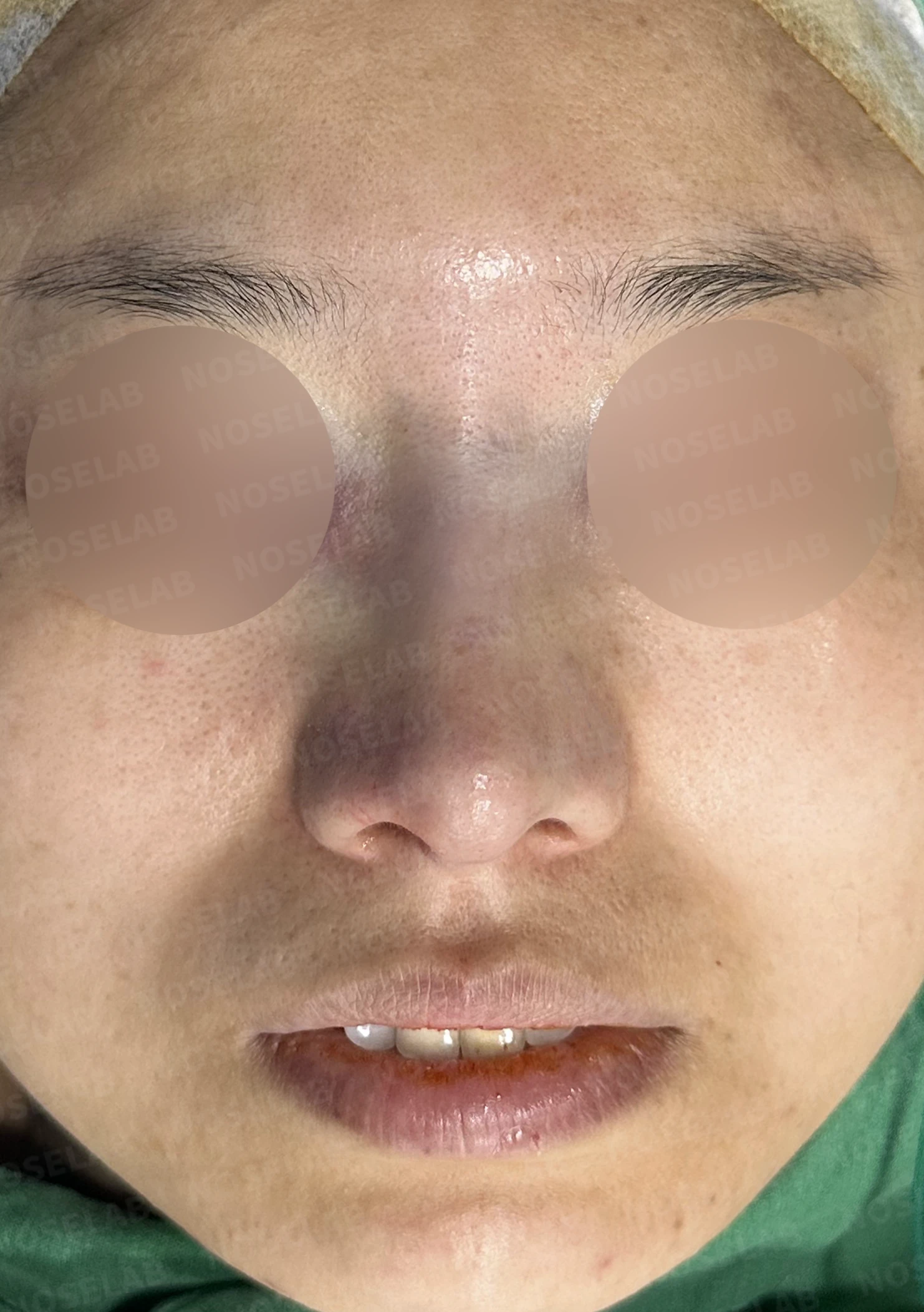 비공 비대칭과 휘어진 코, 자가늑연골 재건으로 교정한 코재수술 — 직후 정면, 비스듬한 측면, 측면 사진