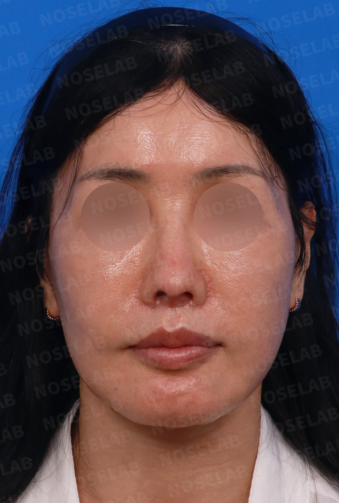 여러 차례 수술 뒤 비중격이 손상되면, 늑연골 재건은 어떻게 하나 — 디자인 상담 정면, 좌측 측면, 비스듬한 측면 사진입니다.