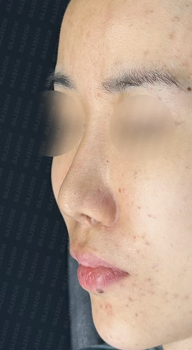 휜코, 뭉툭하고 처진코 수술 사례_대표원장 강차영 — 본문 사진 3