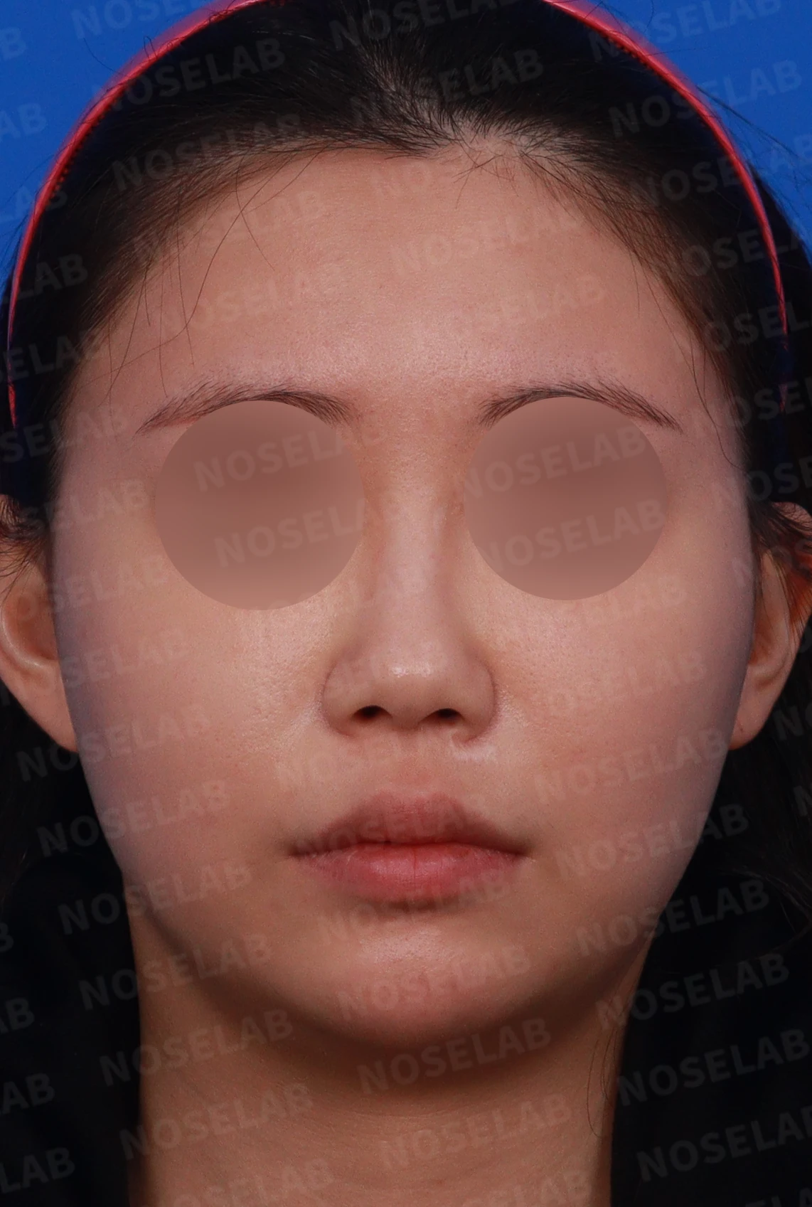 필러와 실이 남아 있는 코, 제거 후 늑연골 재건은 어디까지 가능한가 — 디자인 상담 정면, 좌측 측면, 비스듬한 측면 사진