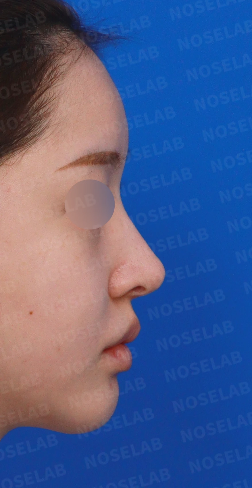 비중격이 심하게 휘고 손상되는 이유, 늑연골 재건은 어떻게 하나 — 디자인 상담 우측 측면, 비스듬한 측면, 비공 사진입니다.