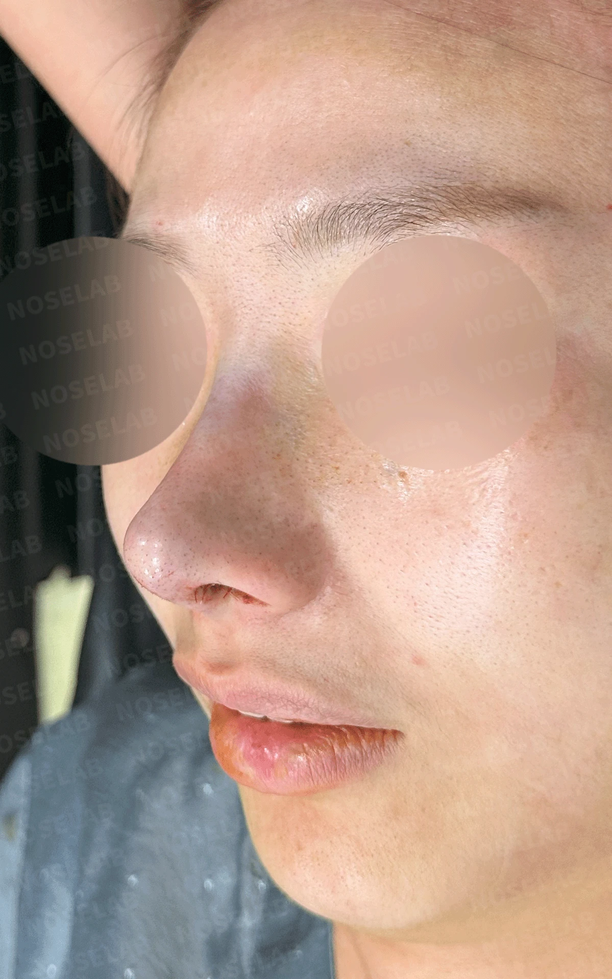 코끝 고어텍스가 문제를 일으키는 이유와 늑연골 비중격 재건 방법 — 수술 직후 0일 정면, 측면, 비스듬한 측면 사진입니다. 직후 사진은 부기가 있는 상태로 최종 결과와 다를 수 있습니다.