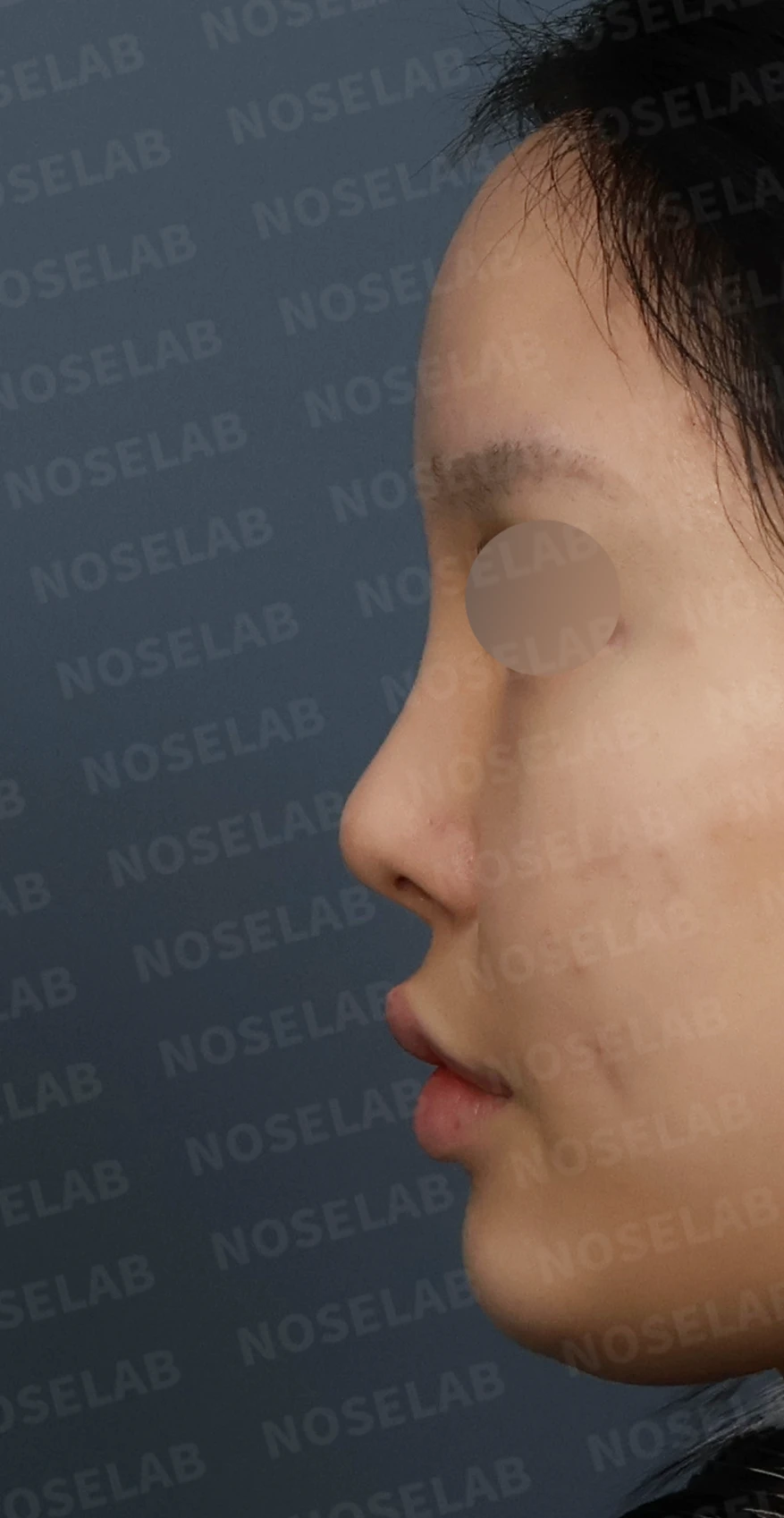 심한 비중격 만곡과 높은 콧대 시작점, 기증늑연골로 정밀 재건 — 디자인 상담 정면, 좌측 측면, 비스듬한 측면 사진입니다.