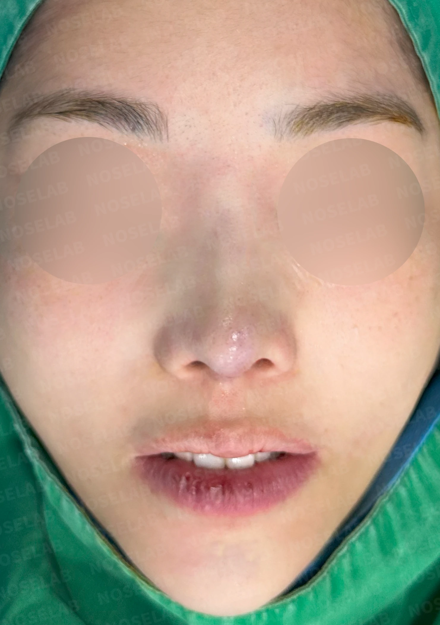 보형물을 넣고 빼기를 반복한 코에 남는 콧등 패임과 들린 느낌 — 수술 전 / 수술 직후 0일 직후 사진은 부기가 있는 상태로 최종 결과와 다를 수 있습니다.