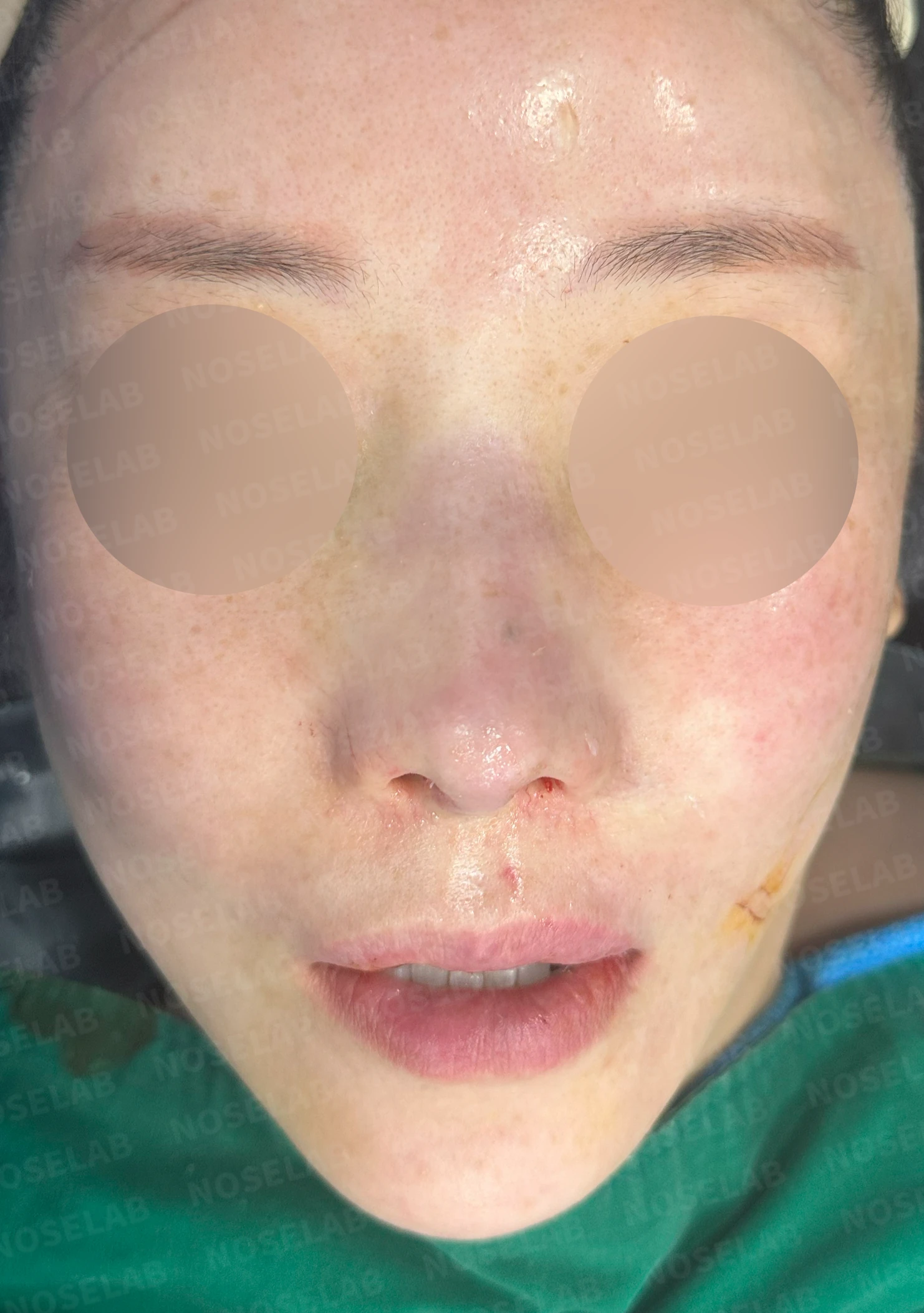 귀족수술 보형물이 코 안으로 밀려 나와 숨이 막히는 이유와 재건 방법 — 본문 사진 9