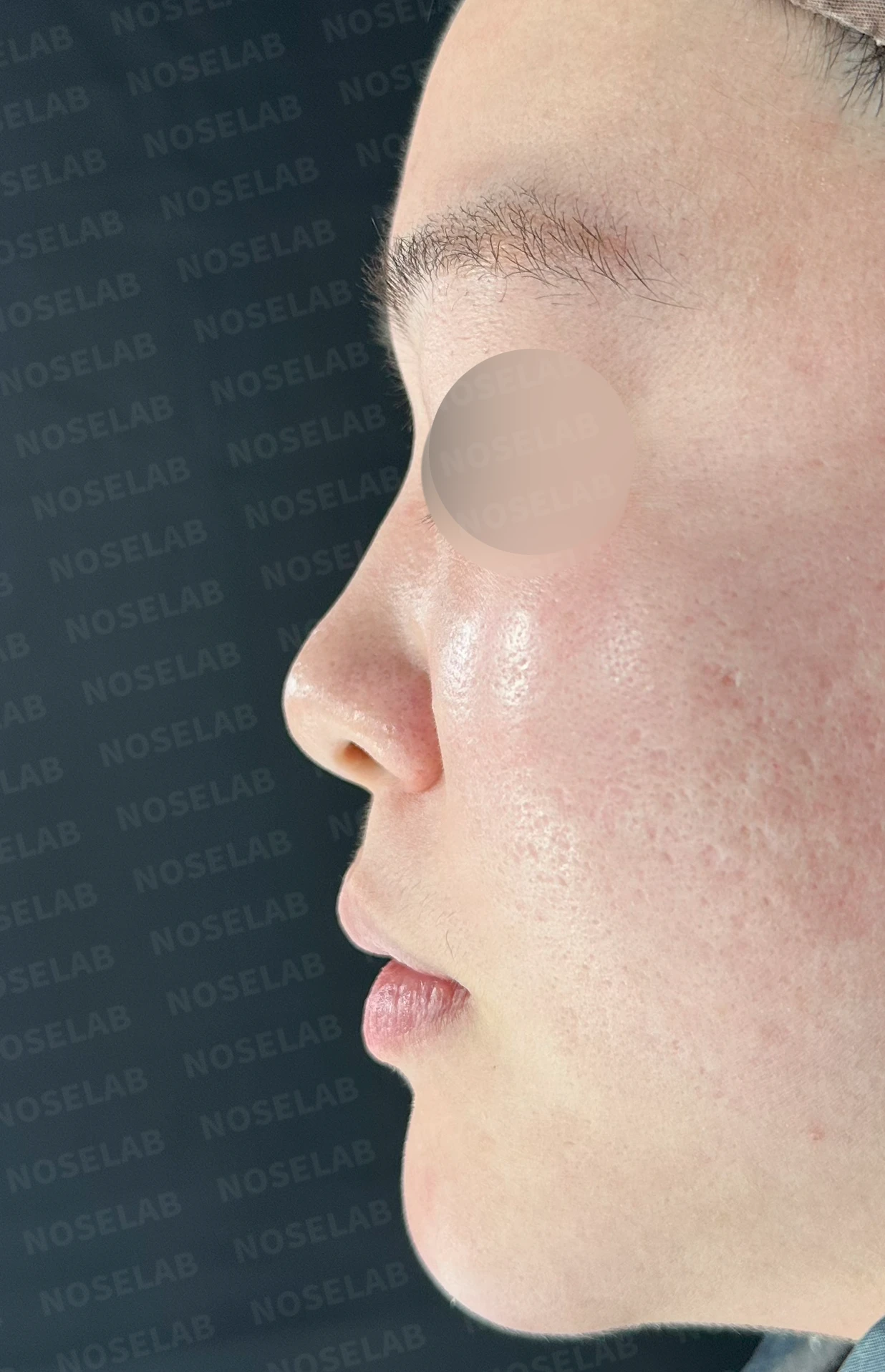 코끝이 퍼지고 입체감이 없어 보이는 이유, 복코 교정은 어떻게 하나 — 수술 전 / 수술 직후 0일 직후 사진은 부기가 있는 상태로 최종 결과와 다를 수 있습니다.