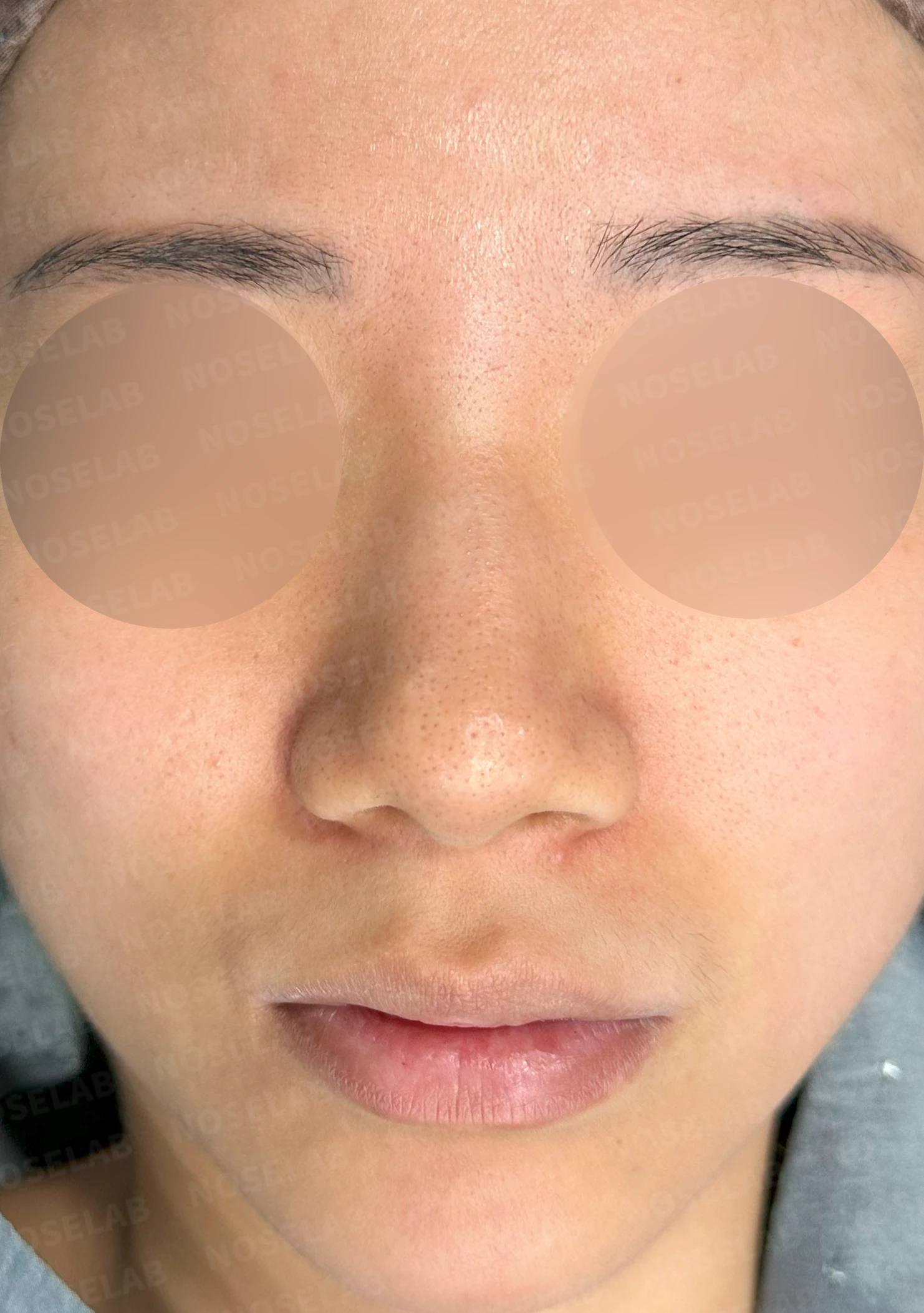 코 필러를 녹이지 않은 채 코가 퍼져 보이는 이유, 얄쌍한 라인을 만드는 방법 — 수술 전 / 수술 직후 0일 직후 사진은 부기가 있는 상태로 최종 결과와 다를 수 있습니다.