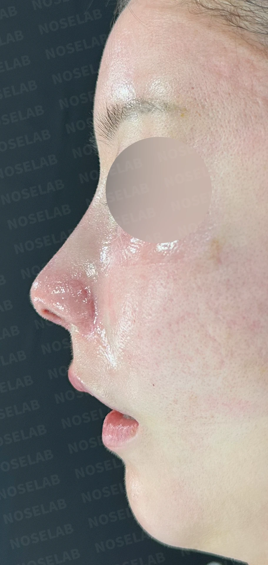 코성형 후 남는 미세한 높이 부족과 좌우 비대칭, 왜 생기고 어떻게 보강하나 — 수술 직후 0일 정면 , 측면 , 비스듬한 측면 사진입니다. 직후 사진은 부기가 있는 상태로 최종 결과와 다를 수 있습니다.