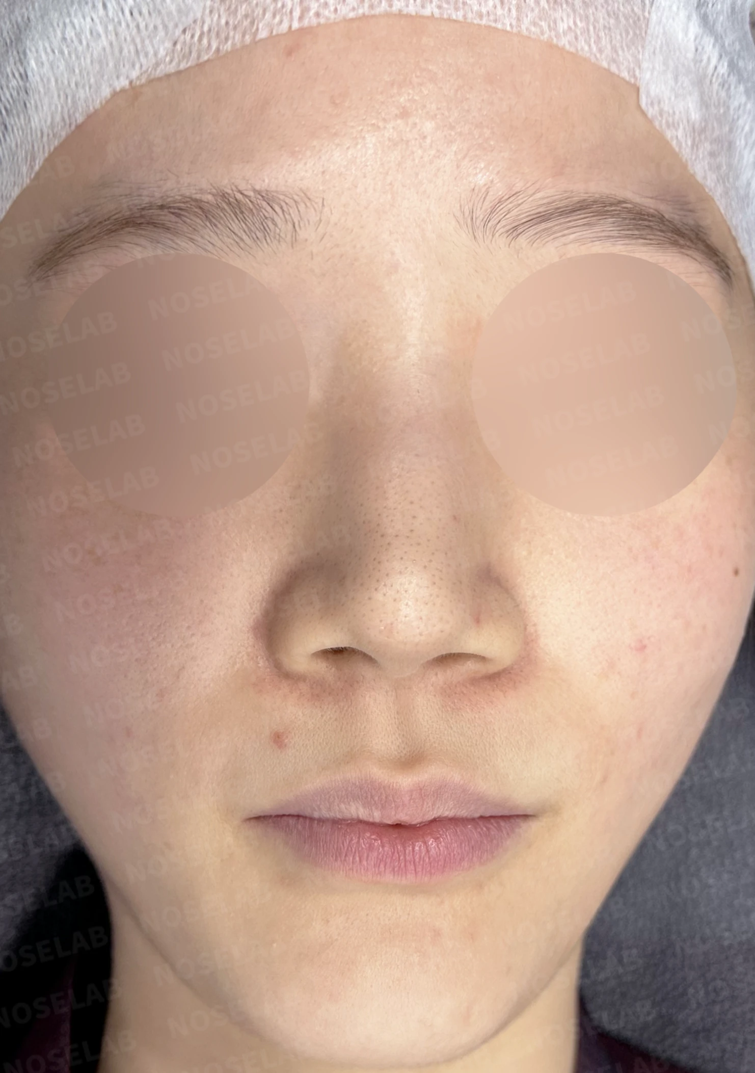 퍼진 코끝에 코막힘이 함께 오는 이유, 이물질 제거와 재건은 어떻게 하나 — 수술 전 / 수술 직후 0일 직후 사진은 부기가 있는 상태로 최종 결과와 다를 수 있습니다.