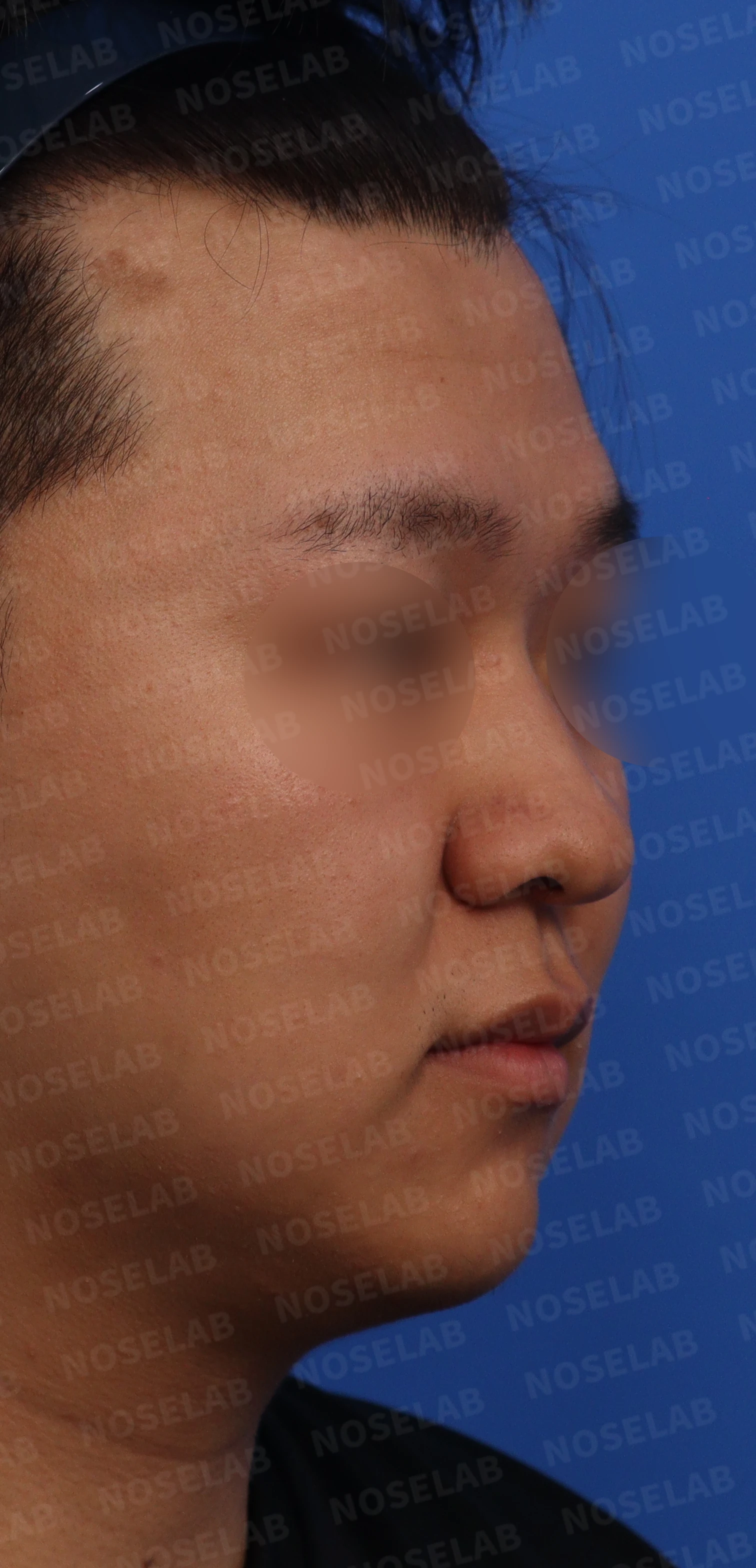 코막힘과 복코를 함께 살펴보는 교정 방법 — 수술전 상담 우측 45도, 우측 90도, 콧구멍 사진