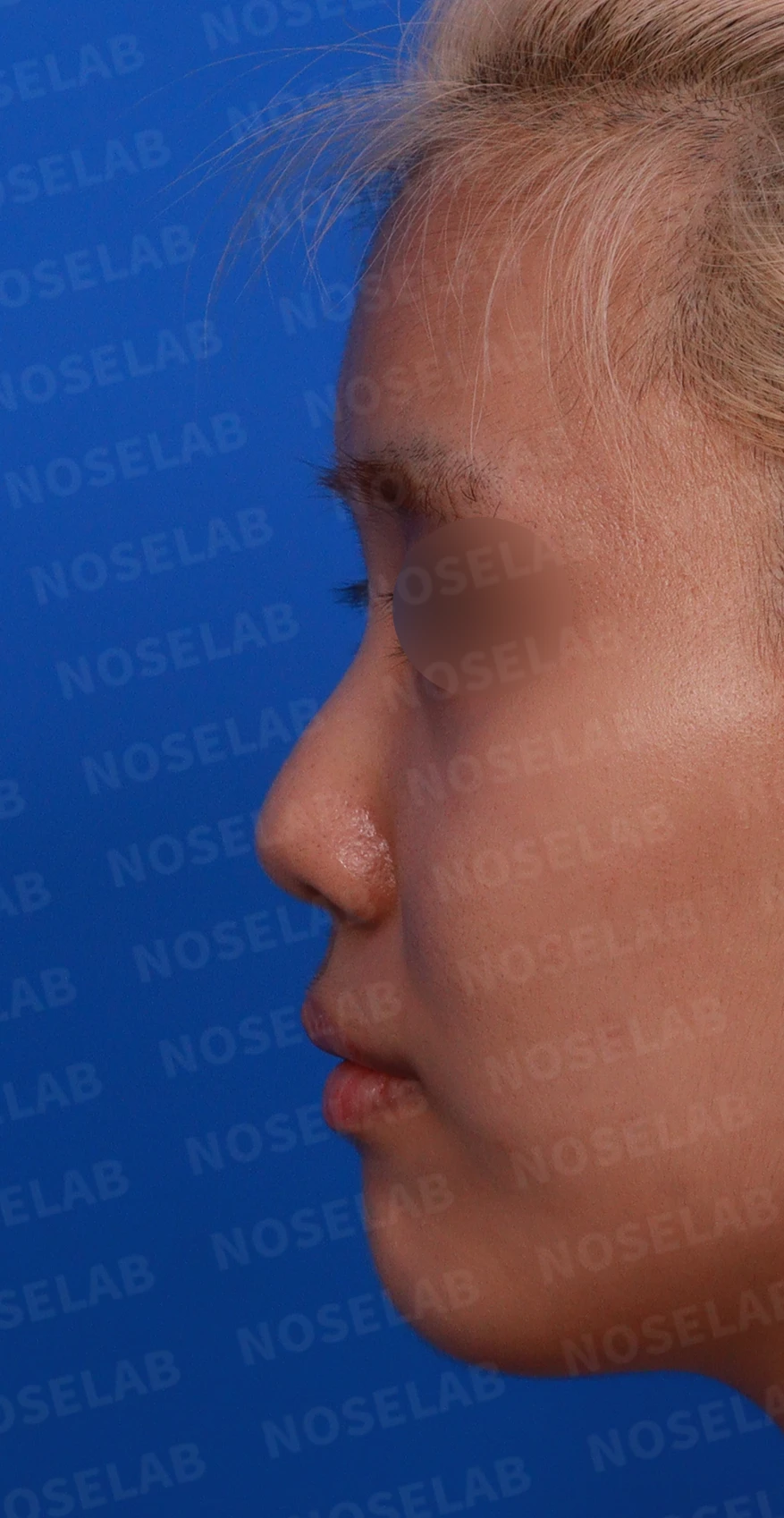 작고 뭉툭한 코는 어디까지 높일 수 있나 — 피부의 한계와 재건 방법 — 디자인 상담 정면 , 좌측 비스듬한 측면 , 측면 사진입니다.