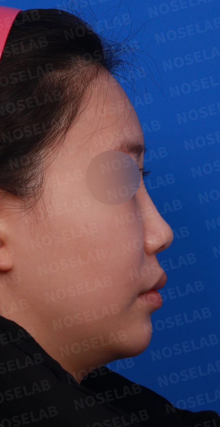 필러와 실이 남아 있는 코, 제거 후 늑연골 재건은 어디까지 가능한가 — 디자인 상담, 우측 비스듬한 측면, 측면, 비공 사진
