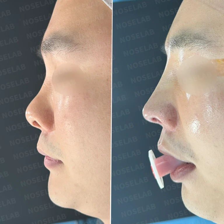 10년 만의 재수술로 찾은 이상적인 코 라인 — 전후 비교