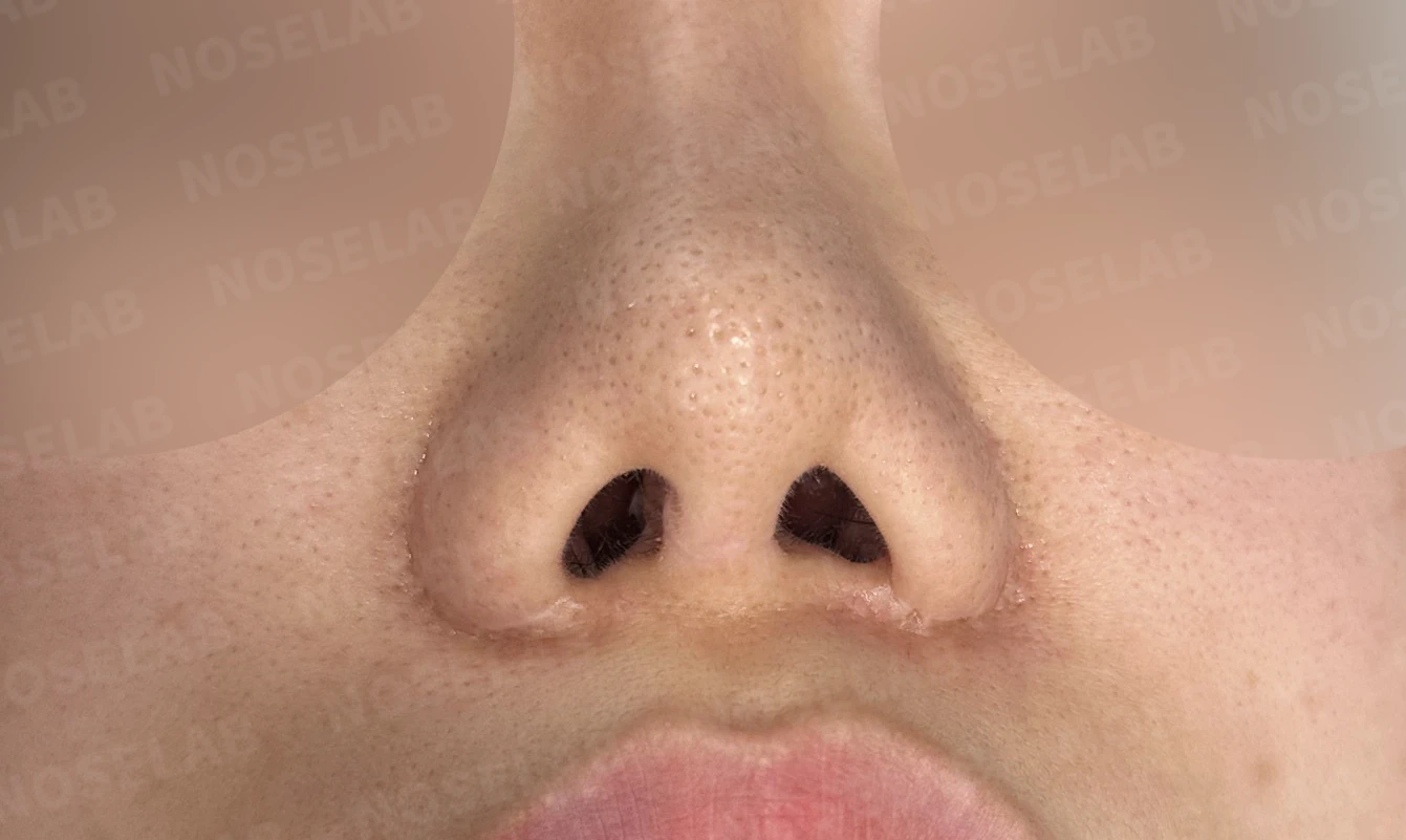 짧은 코와 복코, 자가늑연골로 세련되게 교정한 코재수술 — 전(좌) 직후(후)