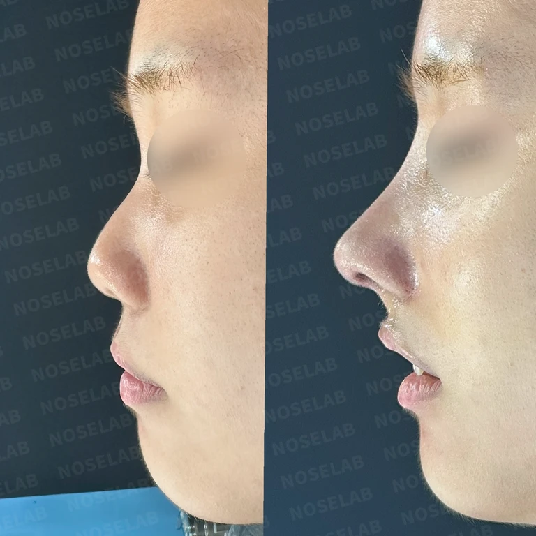 작고 뭉툭한 코를 화려하고 세련되게 - 피부 안전 범위 내 최대 확장 실제 후기 — 전후 비교