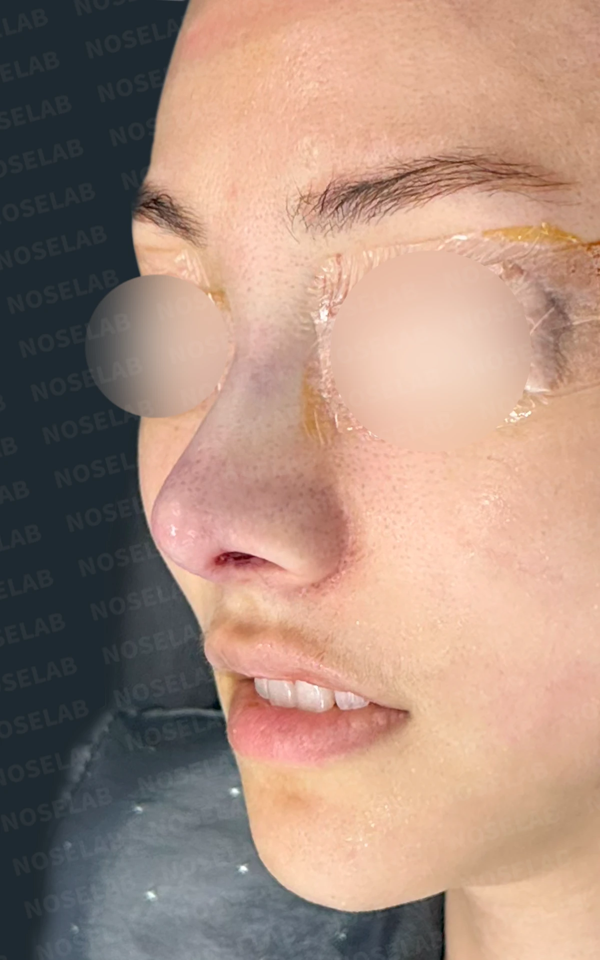 필러와 실 시술을 반복한 코에 미간이 퍼지고 코끝이 들리는 이유 — 수술 직후 0일 정면 , 비스듬한 측면 , 측면 사진 입니다. 직후 사진은 부기가 있는 상태로 최종 결과와 다를 수 있습니다.