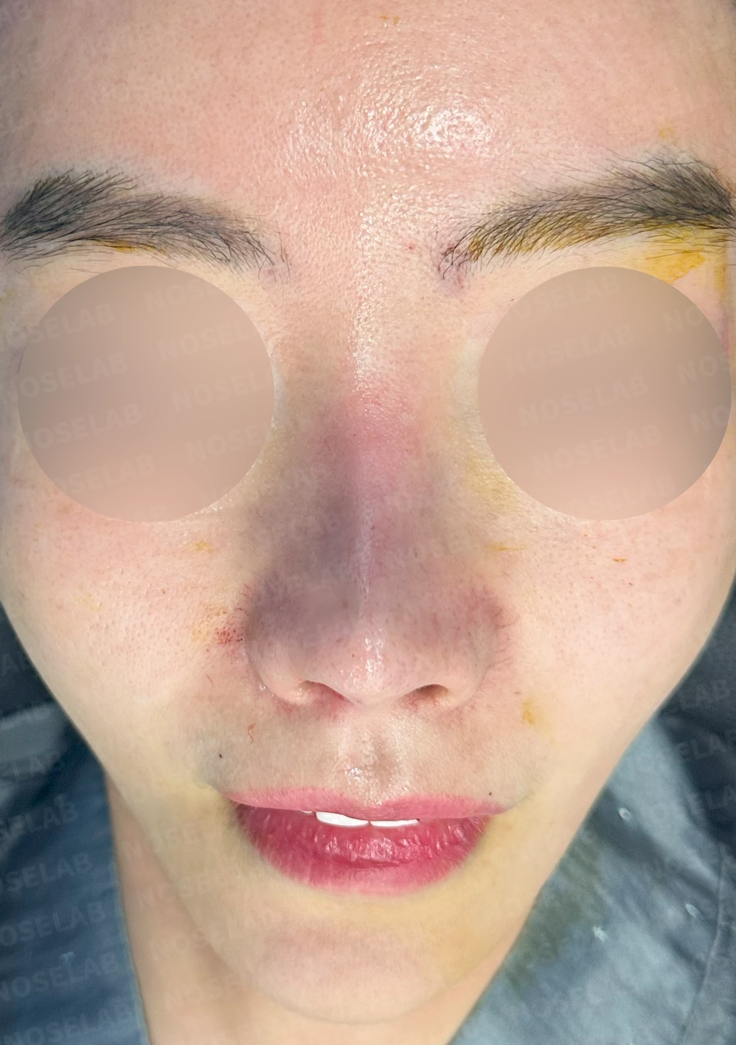 이식한 진피가 반복해서 흡수되는 이유, 재건은 어떻게 하나 — 수술 전 / 수술 직후 0일 직후 사진은 부기가 있는 상태로 최종 결과와 다를 수 있습니다.