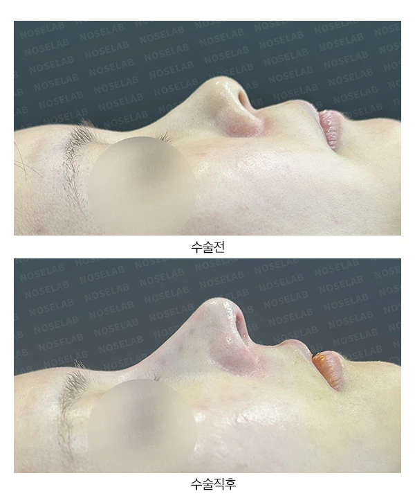 필러 맞고 퍼진 코 교정 방법 — 전후 비교
