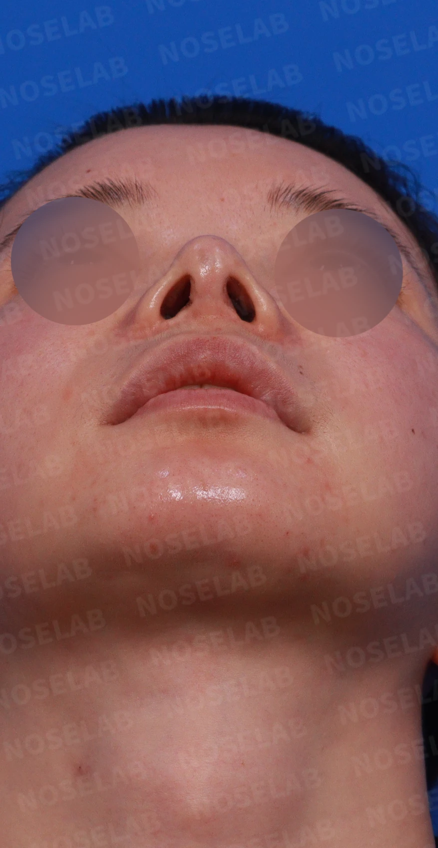 코끝 피부 상태와 괴사 위험을 고려한 재수술 계획 — 수술전 디자인 상담 정면, 측면, 비스듬한 측면 [들린코, 퍼진코, 휜코]