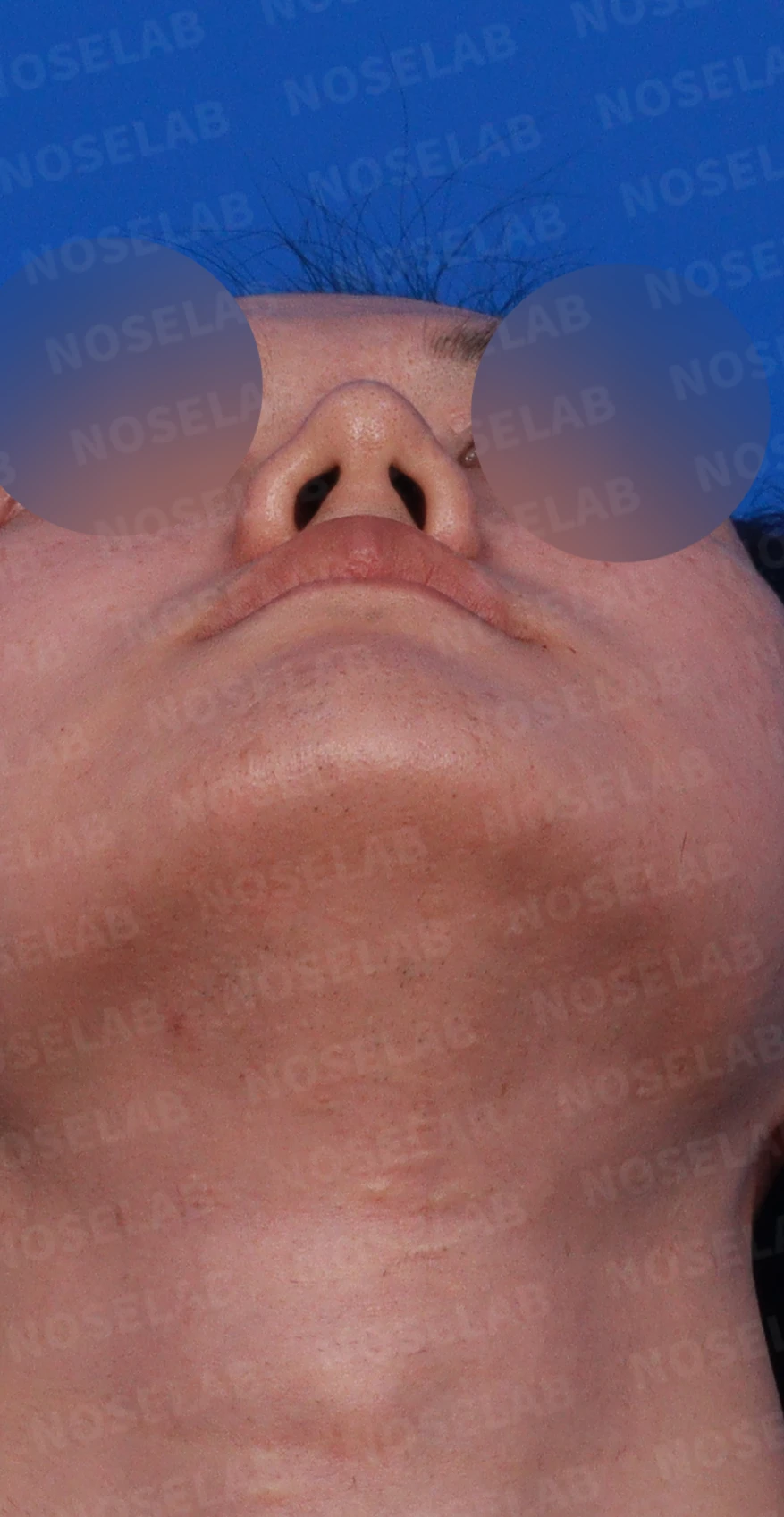 보형물 없이 코끝과 경계 부분만 교정하는 방법 — 디자인 상담 비스듬한 측면 , 우측 측면, 비공 사진