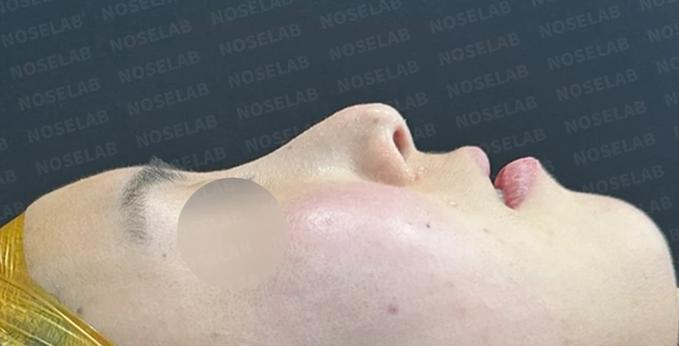 기능성 코성형·휘어진 비주 바로잡기 방법 — 수술 전 / 수술 직후 0일 직후 사진은 부기가 있는 상태로 최종 결과와 다를 수 있습니다.